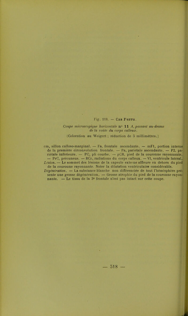 Coupe microscopique horizontale n 11 A, passant au-dessus de la voûte du corps calleux. (Coloration au Weigerl ; réduction de 5 millimètres.) cm, sillon calloso-marginal. — Fa, frontale ascendante. — mFl, portion interne de la première circonvolution frontale. — Pa, pariétale ascendante. — P2, pa- riétale inférieure. — PC, pli courbe. — pCR, pied de la couronne rayonnante. — PrC, précuneus. — RCc, radiations du corps calleux. — VI, ventricule laléral. Lésion. — Le sommet des lésions de la capsule externe affleure en dehors du pied de la couronne rayonnante. Noter la dilatation ventriculaire considérable. Dégénération. — La substance blanche non différenciée de tout l'hémisphère pré- sente une grosse dégénération. — Grosse atrophie du pied de la couronne rayon- nante. — Le tissu de la 3^ frontale n'est pas intact sur cette coupe. — 518 — I f
