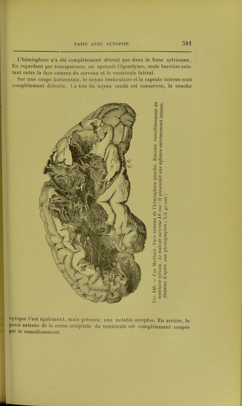 L'hémisphère n'a été complètement détruit que dans la fosse sylvienne. En regardant par transparence, on aperçoit lependyme, seule barrière exis- tant entre la face externe du cerveau et le ventricule latéral. Sur une coupe horizontale, le noyau lenticulaire et la capsule interne sont complètement détruits. La tète du noyau caudé est conservée, la couche ■M C c <o £ a S S <n O tn 03 = S O O) s e ce <o Ë .£ o £fl G * ^ eu 3 3 es c -S J2 tn -0) Ci, tn CL S 3 -a; c JS eo Se Oo >>< uja <a ta S a> S eu Ol es to e> o 60 es a O U. o S -3 D. J2 o c '5 3 S a en .S •0) to fi eo '> a. O >^ es tn T3 1 tl3 -ai a O '3 -«!< ess 'u 6 optique l'est également, mais présente une notable atrophie. En arrière, la paroi externe de la corne occipitale du ventricule est complètement coupée par le ramollissement.