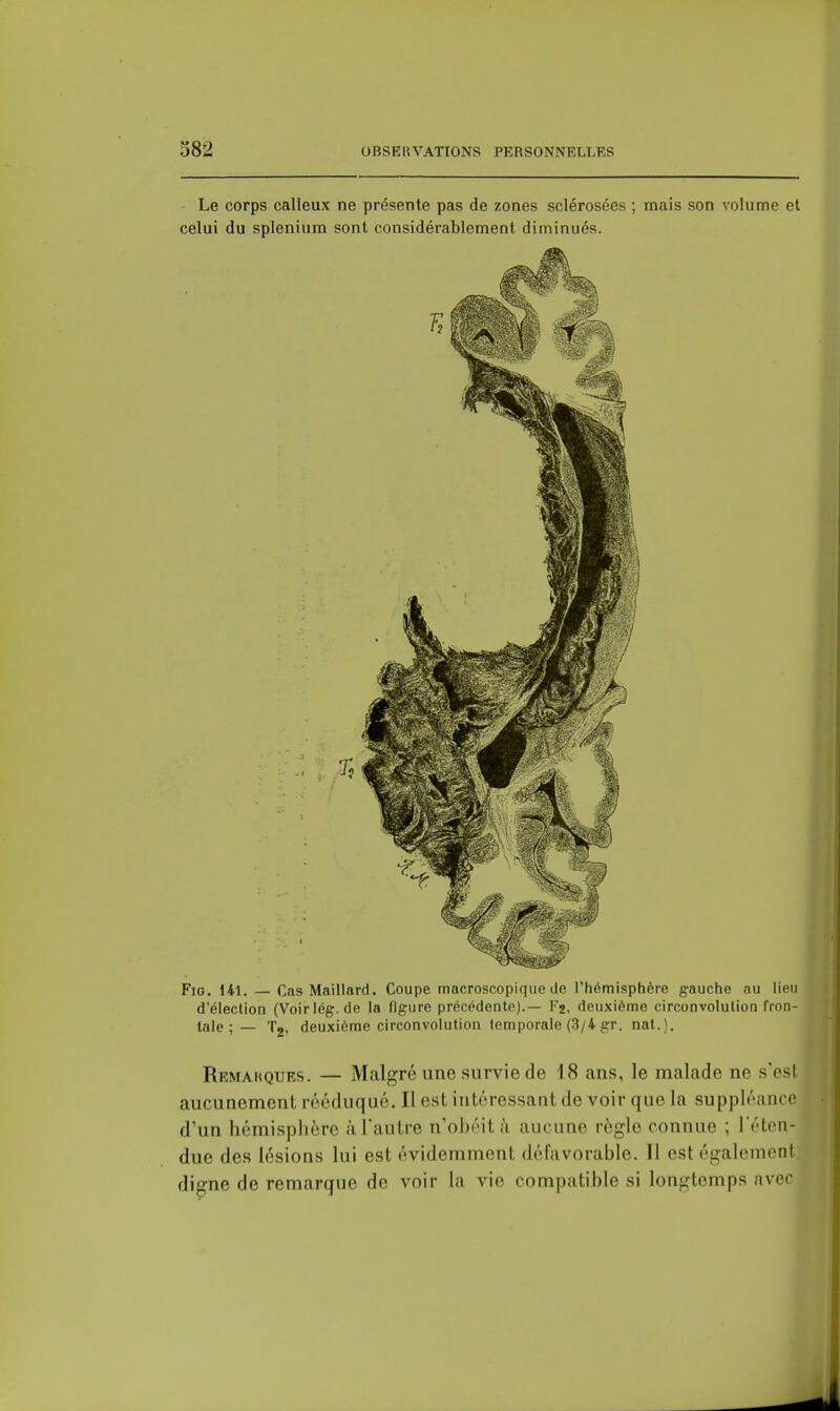 Le corps calleux ne présente pas de zones sclérosées ; mais son volume et celui du splenium sont considérablement diminués. FiG. 141. — Cas Maillard. Coupe macroscopique de Thémisphère gauche au lieu d'élection (Voirlég. de la figure précédente).— Fj, deuxième circonvolution fron- tale; — Tj, deuxième circonvolution temporale (.3/4 gr. nal.). Remarques. — Malgré une survie de 18 ans, le malade ne s'est aucunement rééduqué. Il est intéressant de voir que la suppléance d'un hémisplière à l'autre n'obéit à aucune règle connue ; 1 éten- due des lésions lui est évidemment défavorable. 11 est également, digne de remarque de voir la vie compatible si longtemps avec ^