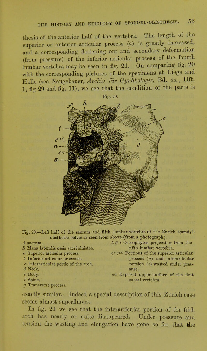 thesis of the anterior half of the vertebra. The length of the superior or anterior articular process (a) is greatly increased, and a corresponding flattening out and secondary deformation (from pressure) of the inferior articular process of the fourth lumbar vertebra may be seen in fig. 21. On comparing fig. 20 with the corresponding pictures of the specimens at Liege and Halle (see Neugebauer, Archiv filr Gynakologie, Bd. xx., Hft. 1, fig 29 and fig. 11), we see that the condition of the parts is Fig. 20. Fig. 20.—Left half of the sacrum and fifth lumbar vertebra of the Zurich spondyl- olisthetic pelvis as seen from above (from a photograph). h cj- i Osteophytes projecting from the fifth lumbar vertebra. cx cxx Portions of the superior articular process (a) and interarticular portion (e) wasted under pres- sure. nn Exposed upper surface of the first sacral vertebra. A sacrum. B Mana lateralis ossis sacri sinistea. a Superior articular process. b Inferior articular processes. c Interarticular portio of the arch. d Neck, e Body. /* Spine. g Transverse process. exactly similar. Indeed a special description of this Zurich case seems almost superfluous. In fig. 21 we see that the interarticular portion of the fifth arch has nearly or quite disappeared. Under pressure and tension the wasting and elongation have gone so far that the