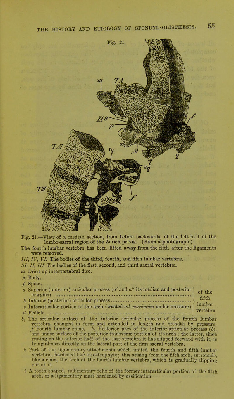 Fig. 21. Fig. 21.—View of a median section, from before backwards, of the left half of the lumbo-sacral region of the Zurich pelvis. (From a photograph.) The fourth lumbar vertebra has been lifted away from the fifth after the ligaments were removed. Ill, IV, VL The bodies of the third, fourth, and fifth lumbar vertebrae. SI, II, III The bodies of the first, second, and third eacral vertebrae. m Dried up intervertebral disc. e Body. / Spine. a Superior (anterior) articular process (a' and a its median and posterior margins) b Inferior (posterior) articular process e Interarticular portion of the arch (wasted ad maximum under pressure) <l Pedicle bt The articular surface of the inferior articular process of the fourth lumbar vertebra, changed in form and extended in length and breadth by pressure, f Fourth lumbar spine. b.2 Posterior part of the inferior articular process (6), and under surface of the posterior transverse portion of its arch ; the latter, since resting on the anterior hatf of the last vertebra it has slipped forward with it, is lying almost directly cn the lateral part of the first sacral vertebra. h Part of the ligamentary attachments which united the fourth and fifth lumbar vertebra?, hardened like an osteophyte; this arising from the fifth arch, surround?, like a claw, the arch of the fourth lumbar vertebra, which is gradually slipping out of it. i A tooth-Bhaped, rudimentary relic of the former interarticular portion of the fifth arch, or a ligamentary mass hardened by ossification. of the fifth lumbar vertebra.