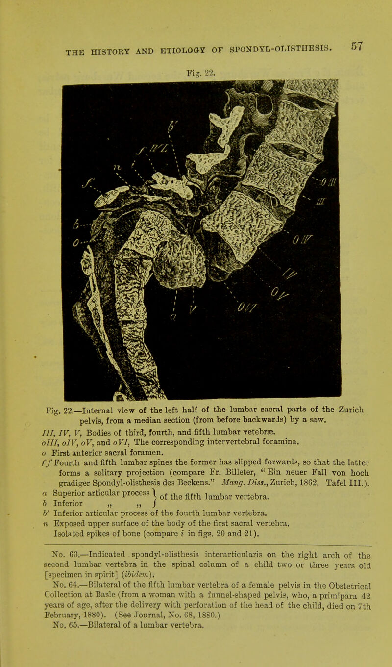 Fig. 22. Fig. 22.—Internal view of the left half of the lumbar sacral parts of the Zurich pelvis, from a median section (from before backwards) by a saw. Ill, IV, V, Bodies of third, fourth, and fifth lumbar vetebrse. oIH, oIV, oV, and oVI, The corresponding intervertebral foramina. o First anterior sacral foramen. ff Fourth and fifth lumbar spines the former has slipped forward?, so that the latter forms a solitary projection (compare Fr. Billeter,  Ein neuer Fall von hoch gradiger Spondyl-olisthesis des Beckens. Mang. Diss., Zurich, 1862. Tafel III.). a Superior articular process 1 Qf ^ fifth lumbar vertebra. b Inferior „ ,, J V Inferior articular process of the fourth lumbar vertebra. n Exposed upper surface of the body of the first sacral vertebra. Isolated spikes of bone (compare i in figs. 20 and 21). No. 63.—Indicated spondylolisthesis interarticularis on the right arch of the second lumbar vertebra in the spinal column of a child two or three years old [specimen in spirit] (ibidem). No. 64.—Bilateral of the fifth lumbar vertebra of a female pelvis in the Obstetrical Collection at Basle (from a woman with a funnel-shaped pelvis, who, a primipara 42 years of age, after the delivery with perforation of the head of the child, died on 7th February, 1880). (See Journal, No. C8, 1880.) No. 65.—Bilateral of a lumbar vertebra.