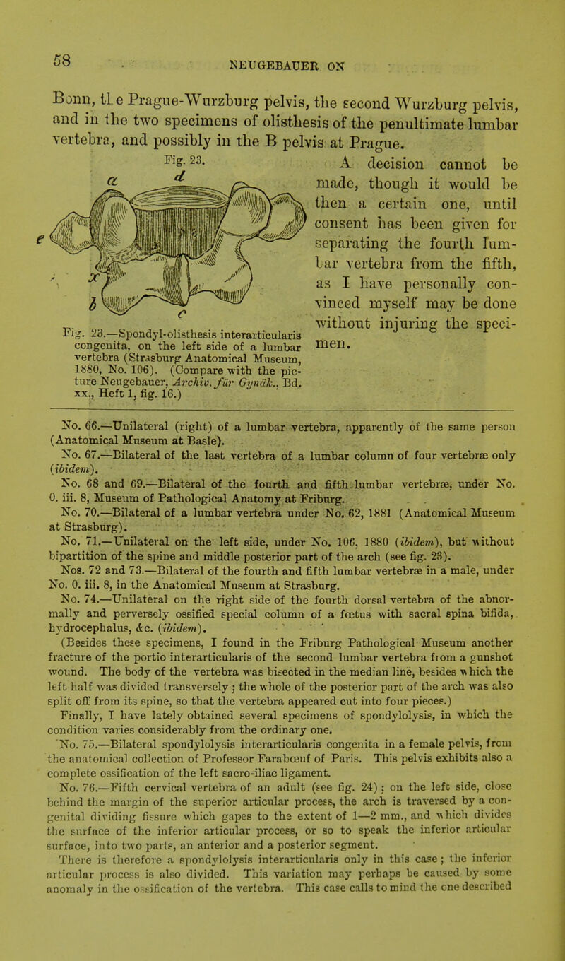 Bonn, tie Prague-Wurzburg pelvis, the second Wurzburg pelvis, and in the two specimens of olisthesis of the penultimate lumbar vertebra, and possibly in the B pelvis at Prague. A decision cannot be made, though it would be then a certain one, until consent has been given for separating the fourth lum- bar vertebra from the fifth, as I have personally con- vinced myself may be done without injuring the speci- men. No. 66.—Unilateral (right) of a lumbar vertebra, apparently of the same person (Anatomical Museum at Basle). No. 67.—Bilateral of the last vertebra of a lumbar column of four vertebrae only {ibidem). No. 68 and 69.—Bilateral of the fourth and fifth lumbar vertebra?, under No. 0. iii. 8, Museum of Pathological Anatomy at Friburg. No. 70.—Bilateral of a lumbar vertebra under No. 62, 1881 (Anatomical Museum at Strasburg). No. 71.—Unilateral on the left Bide, under No. 106, 1880 {ibidem), but without bipartition of the spine and middle posterior part of the arch (see fig. 23). Nos. 72 and 73.—Bilateral of the fourth and fifth lumbar vertebra? in a male, under No. 0. iii. 8, in the Anatomical Museum at Strasburg. No. 74.—Unilateral on the right side of the fourth dorsal vertebra of the abnor- mally and perversely ossified special column of a foetus with sacral spina bifida, hydrocephalus, &.c. {ibidem). (Besides these specimens, I found in the Friburg Pathological Museum another fracture of the portio interarticularis of the second lumbar vertebra from a gunshot wound. The body of the vertebra was bisected in the median line, besides \s hich the left half was divided transversely ; the whole of the posterior part of the arch was also split off from its spine, so that the vertebra appeared cut into four pieces.) Finally, I have lately obtained several specimens of spondylolysis, in which the condition varies considerably from the ordinary one. No. 75.—Bilateral spondylolysis interarticularis congenita in a female pelvis, from the anatomical collection of Professor Farabceuf of Paris. This pelvis exhibits also a complete ossification of the left sacro-iliac ligament. No. 76.—Fifth cervical vertebra of an adult (see fig. 24); on the left side, close behind the margin of the superior articular process, the arch is traversed by a con- genital dividing fissure which gapes to the extent of 1—2 mm., and which divides the surface of the inferior articular process, or so to speak the inferior articular surface, into two partp, an anterior and a posterior segment. There is therefore a spondylolysis interarticularis only in this case; the inferior articular process is also divided. This variation may perhaps be caused by some anomaly in the ossification of the vertebra. This case calls to mind the one described Fig. 23. Fig. 23.—Spondyl-olisthesis interarticularis congenita, on the left side of a lumbar vertebra (Strasburg Anatomical Museum, 1880, No. 106). (Compare with the pic- ture Neugebauer, Archiv.fur Gynalc, Bd.