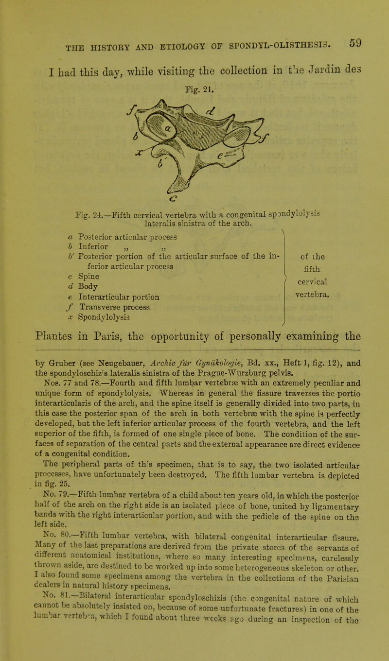 I bad this day, while visiting the collection in the Jardin de3 Fig. 21. Fig. 24.—Fifth cervical vertebra with a congenital spondylolysis lateralis sinistra of the arch. a Posterior articular process b Inferior „ „ b' Fosterior portion of the articular surface of the in ferior articular process c Spine d Body e Interarticular portion f Transverse process x Spondylolysis of the fifth ( cervical vertebra. Plantes in Paris, the opportunity of personally examining the by Gruber (see Neugebauer, Archio fur Gynakologie, Bd. xx., Heft 1, fig. 12), and the spondyloschiz;s lateralis sinistra of the Prague-Wurzburg pelvis. Nos. 77 and 78.—Fourth and fifth lumbar vertebrae with an extremely peculiar and unique form of spondylolysis. Whereas in general the fissure traverses the portio interarticularis of the arch, and the spine itself is generally divided into two parts, in this case the posterior span of the arch in both vertebrae with the spine is perfectly developed, but the left inferior articular process of the fourth vertebra, and the left superior of the fifth, is formed of one single piece of bone. The condition of the sur- faces of separation of the central parts and the external appearance are direct evidence of a congenital condition. The peripheral parts of th's specimen, that is to say, the two isolated articular processes, have unfortunately teen destroyed. The fifth lumbar vertebra is depicted in fig. 25. No. 79.—Fifth lumbar vertebra of a child about ten years old, in which the posterior half of the arch on the right side is an isolated piece of bone, united by ligamentary bands with the right interarticular portion, and with the pedicle of the spine on the left side. No. 80.—Fifth lumbar vertebra, with bilateral congenital interarticular fissure. Many of the last preparations are derived from the private stores of the servants of different anatomical institutions, where so many interesting specimens, carelessly thrown aside, are destined to be worked up into some heterogeneous skeleton or other. I also found some specimens among the vertebra in the collections of the Parisian dealers in natural history specimens. No. 81.—Bilateral interarticular spondyloschizis (the congenital nature of which cannot be absolutely insisted on, because of some unfortunate fractures) in one of the lumbar verteb-a, which I found about three weeks ago during an inspection of the