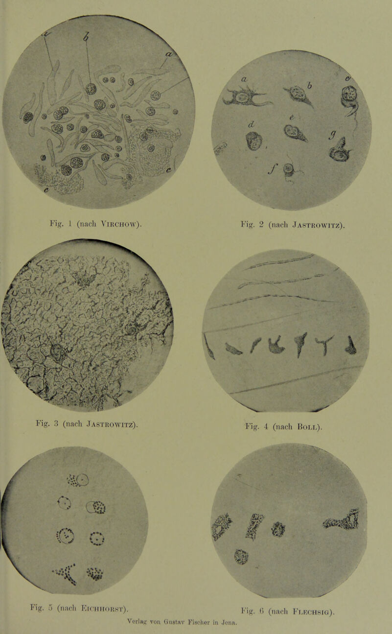 OA A 1 a f a- 5? Fig. 1 (nacli Virchow). Fig. 2 (nacli Jastrowitz), Fig. 3 (nach Jastrowitz). Fig. 4 (nach Boll). Fig. 5 (nacli Eichhorst). Fig. o (nach Ff.rchhig). Vcrlaf,' voii Gustav Fischer in Jona.