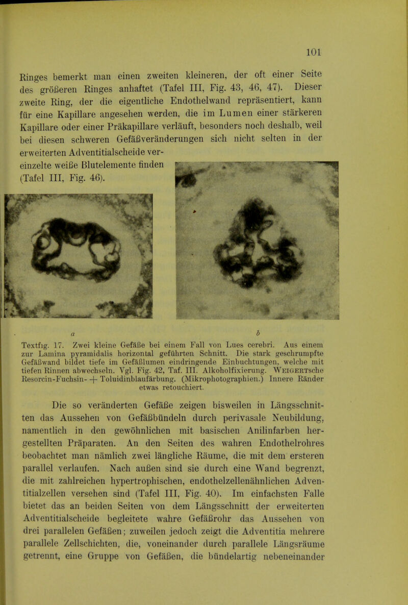 Ringes bemerkt man einen zweiten kleineren, der oft einer Seite des groBeren Ringes anhaftet (Tafel III, Fig. 43, 46, 47). Dieser zweite Ring, der die eigentliche Endothelvvand reprasentiert, kann fiir eine Kapillare angesehen werden, die im Lumen einer starkeren Kapillare oder einer Prakapillare verlauft, besonders noch deshalb, weil bei diesen schweren GefaBveranderungen sich nicht selten in der erweiterten Adventitialscheide ver- Textfig. 17. Zwei kleine GefaBe bei einem Fall von Lues cerebri. Aus einem zur Lamina pyramidalis horizontal gefiihrten Schnitt. Die stark geschrunipfte Gefafiwand bildet tiefe im GefaBlumen eindringende Einbuchtungen, welche mit tiefen Rinnen abwechseln. Vgl. Fig. 42, Taf. III. Alkoholfixierung. WEiGERTsche Resorcin-Fuchsin- -f- Toluidinblaufarbung. (Mikrophotograpbien.) Innere Rander etwas retouchiert. Die so veranderten GefaBe zeigen bisweilen in Langsschnit- ten das Aussehen von GefaBbiindeln durch perivasale Neubildung, namentlich in den gewdhnlichen mit basischen Anilinfarben lier- gestellten Praparaten. An den Seiten des wahren Endothelrohres beobachtet man namlich zwei langliche Raume, die mit dem ersteren parallel verlaufen. Nach auBen sind sie durch eine Wand begrenzt, die mit zahlreichen hypertrophischen, endothelzellenahnlichen Adven- titialzellen versehen sind (Tafel III, Fig. 40). Im einfachsten Falle bietet das an beiden Seiten von dem Langsschnitt der erweiterten Adventitialscheide begleitete wahre GefaBrohr das Aussehen von drei parallelen GefaBen; zuweilen jedoch zeigt die Adventitia mehrere parallele Zellschichten, die, voneinander durch parallele Langsraume getrennt, eine Gruppe von GefaBen, die bundelartig nebeneinander