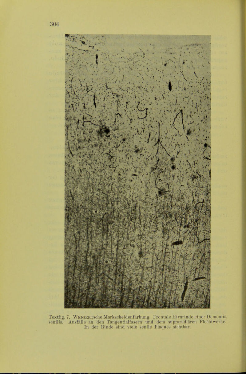 Textfig. 7. WEiGERTsche Mai-kscheidenfarbung. Frontale Hirnniule einer Dementia senilis. Ausfalle an den Tangentialfasern iind dem siipraradiilren Flechtwerke. In der Rinde sind viele senile Plaques siclitbar.