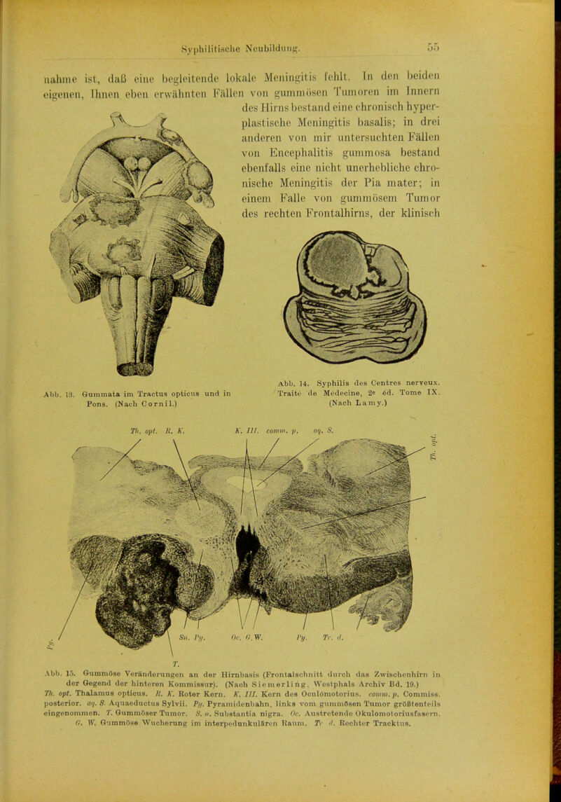 aahme ist, daB eine begleitende lokale Meniugitis Eehlt, In den beidon eigenen, lhnen ebon erwahnten Fallen von gummoscii Tumoren im Innern des Hirns bestand eine chronisch hyper- plastische Meningitis basalis; in drei anderen von inir nntersuchten Fallen von Encephalitis gummosa bestand ebenfalls eine nicht unerhebliche chro- nische Meningitis der Pia mater; in einem Falle von gummosem Tumor des rechten Frontalhirns, der klinisch Abb. 18. Gummuta im Tractus opticus und in Pons. (Nach Cor nil.) Abb. 14. Syphilis des Centres nerveux. Traits da Medecine, 2e ed. Tome IX. (Nach La my.) Tli. opt. It. K. A'. ///. comm. p. aq. S. S». Fff, Oc. n.W. I'y. Tr. <?. Abb. 15, GummOse Vorttnderungen an dor Hirnbasis (Prontalgchuitt duroh das Zwischenhirn in der Oegend dor hinteren Konimissnr). (Naoh Siemorling. Westphals Archiv Bd. 19.) Tli. opt. Thalamus opticus. /.'. A'. Roter Kern. A'. ///. Korn dos Oculomotomis. romm.p. Commiss. posterior, aq. 8. Aquaeductus Sylvii. Fff, Pyramid<'nl>ahn. links voni giimmOson Tumor grOBtenteils cingenommon. 7. GummOser Tumor. S, fl. Substantia nigra. Oft Austretondc Okulomotoriiisfasern. 0, \V. GummOse Wucherung im iiiterpr-dunkulftrc n Knimi. Tr Reehter Tracktus.