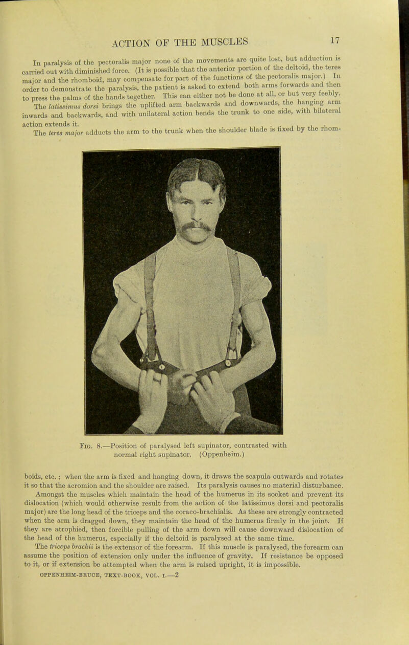 In paralysis of the pectoral* major none of the movements are quite lost, but adduction is carried out with diminished force. (It is possible that the anterior portion of the deltoid, the teres major and the rhomboid, may compensate for part of the functions of the pectoral* major ) In order to demonstrate the paralysis, the patient is asked to extend both arms forwards and then to press the palms of the hands together. This can either not be done at all or but very feebly. The latissimu* dorsi brings the uplifted arm backwards and downwards, the hanging arm inwards and backwards, and with unilateral action bends the trunk to one side, with bilateral action extends it. ,, _ . „ , , ., , The (ere, major adducts the arm to the trunk when the shoulder blade is fixed by the rhom- Fig. 8.—Position of paralysed left supinator, contrasted with normal right supinator. (Oppenheim.) boids, etc. ; when the arm is fixed and hanging down, it draws the scapula outwards and rotates it so that the acromion and the shoulder are raised. Its paralysis causes no material disturbance. Amongst the muscles which maintain the head of the humerus in its socket and prevent its dislocation (which would otherwise result from the action of the latissimus dorsi and pectoralis major) are the long head of the triceps and the coraco-brachialis. As these are strongly contracted when the arm is dragged down, they maintain the head of the humerus firmly in the joint. If they are atrophied, then forcible pulling of the arm down will cause downward dislocation of the head of the humerus, especially if the deltoid is paralysed at the same time. The triceps brachii is the extensor of the forearm. If this muscle is paralysed, the forearm can assume the position of extension only under the influence of gravity. If resistance be opposed to it, or if extension be attempted when the arm is raised upright, it is impossible. OPPENHEIM-BRUOE, TEXT-BOOK, VOL. I.—2