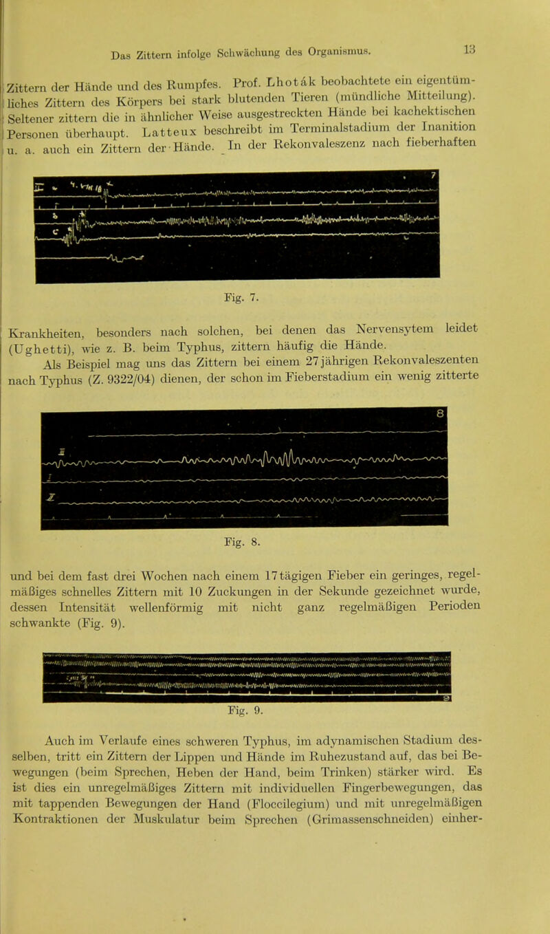 Das Zittern infolge Schwachung des Organismus. Zittern der Hande and des Rumpfes. Prof. Lhotak beobachtete eni eigentum- liches Zittern des Korpers bei stark blutenden Tieren (mundliohe Mitteuung). Seltener zittern die in ahnlicher Weise ausgestrecktcn Hande bei kachektischen Personen iiberhaupt. Latteux bescbreibt im Terminalstadium der Inanition u a auch ein Zittern der Hande. In der Rekonvaleszenz nach fieberhaften Fig. 7. Krankheiten, besonders nacb solchen, bei denen das Nervensytern leidet (Ughetti), wie z. B. beim Typhus, zittern haufig die Hande. Als Beispiel mag uns das Zittern bei einem 27jahrigen Rekonvaleszenten nach Typhus (Z. 9322/04) dienen, der schon im Fieberstadium ein wenig zitterte Fig. 8. und bei dem fast drei Wochen nach einem 17tagigen Fieber ein geringes, regel- maBiges schnelles Zittern mat 10 Zuckungen in der Sekunde gezeichnet wurde, dessen Intensitat wellenformig mit nicht ganz regelmaBigen Perioden schwankte (Fig. 9). Fig. 9. Auch im Verlaufe eines schweren Typhus, im adynamischen Stadium des- selben, tritt ein Zittern der Lippen und Hande im Ruhezustand auf, das bei Be- wegungen (beim vSprechen, Heben der Hand, beim Trmken) starker wird. Es ist dies ein unregelmafiiges Zittern mit individuellen Fingerbewegungen, das mit tappenden Bewegungen der Hand (Floccilegium) und mit unregelmiifJigen Kontraktionen der Muskulatur beim Sprechen (Grimassenschneiden) einher-