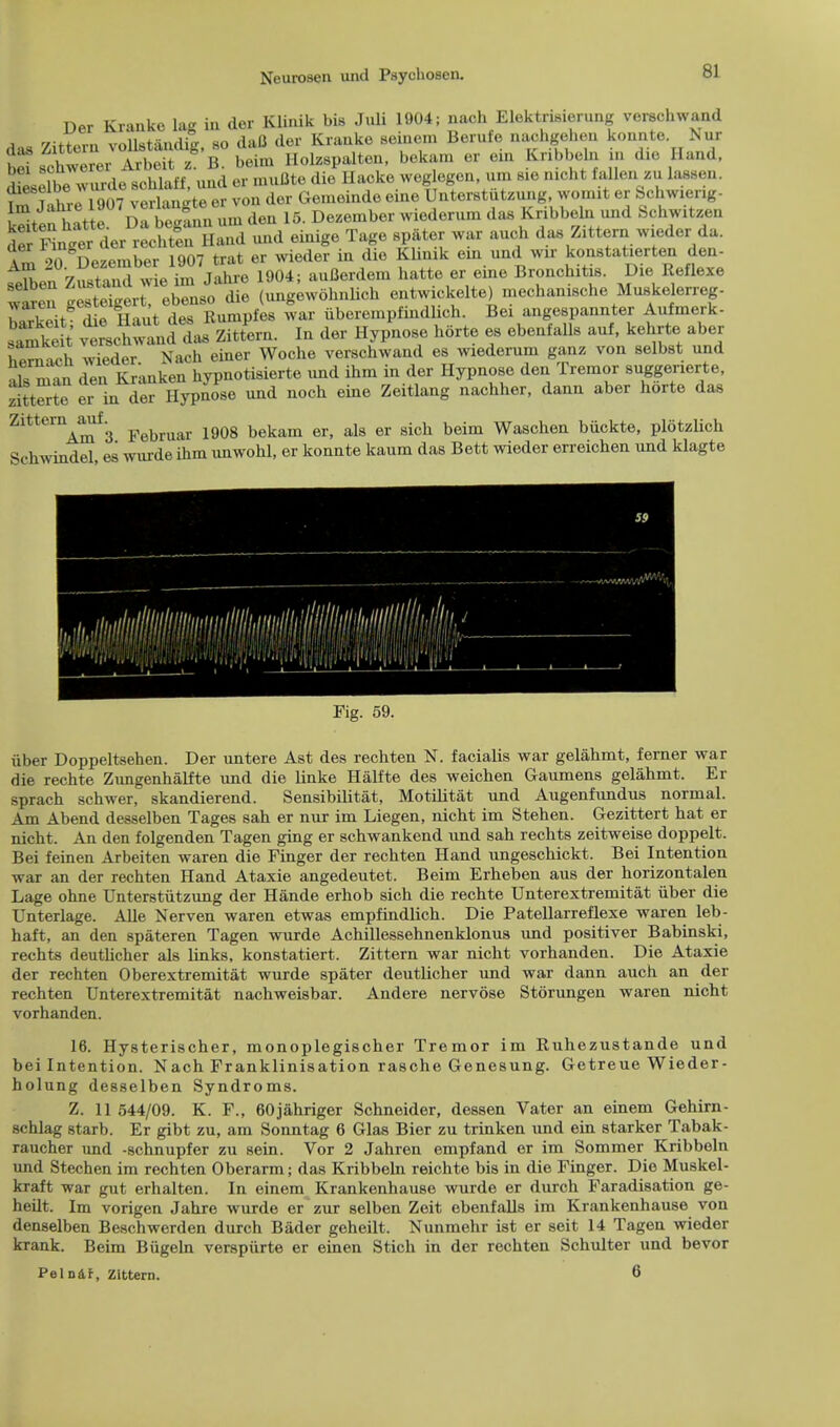 Der Kraukc lag in der Klinik bis Juli 1904; nach Elektrisierung verschwand a r/Jt+lm vnHstandS so daQ dor Krauke seinem Beruio iiachgehon kounte. Nur bei ^hworer Arbdt z^'b beim Holzspalton, bekam or oin Kribbeln in dio Hand, dSselbo wurde scblaff, und or muBte die Hacko weg egcn urn 816 nicht fallen m lasson. i I! 007 verlm-te or von dor Gemeinde eine Unterstutzung, womit er S>chwieng- Kten h'to DrKm am don 15. Dozombor wiodorum das Kribbeln und Schwitzen £ Kn^er rLSeTHand und oinigo Tago spater war auch das Zittern wieder da. a™ Vn iLember 1907 trat or wieder in die Klinik ein und wir konstatierten den- i£JZ ZuSd wie to JaSe 1904; auBerdem batte er eine Bronchitis. Die Roflexe ^esWer obenso die (ungewohnlich entwiekelte) mechanische Muskelerreg- r ^itgir Haut doT Rumples war iiberempfiudlich. Bei angespannter Aufmerk- satk t vtsch^d daTzit/orn. In der Hypnose horto es ebenfalls auf, kehrte aber hPm ich wieder Nach einer Woche verschwand es wiederum ganz von selbst und >U man den Kranken hypnotisierte und ihm in der Hypnose den Tremor suggenerte, tttZZ>Z \n Z Hypnose und noch eine Zoitlang nachher, danu aber horte das Zittern^ajiL m& bekam er> als er sich beim Waschen buckte, plotzlich Schwindel, es wurde ihm unwohl, er konnte kaum das Bett wieder erreichen und klagte Fig. 59. iiber Doppeltsehen. Der untere Ast des rechten N. facialis war gelahmt, ferner war die rechte Zungenhalfte und die linke Halfte des weichen Gaumens gelahmt. Er sprach schwer, skandierend. Sensibilitat, Motilitiit und Augenfundus normal. Am Abend desselben Tages sah er nur im Liegen, nicht im Stehen. Gezittert hat er nicht. An den folgenden Tagen ging er schwankend und sah rechts zeitweise doppelt. Bei feinen Arbeiten waren die Finger der rechten Hand ungeschickt. Bei Intention war an der rechten Hand Ataxie angedeutet. Beim Erheben aus der horizontalen Lage ohne Unterstutzung der Hande erhob sich die rechte Unterextremitat iiber die Unterlage. Alle Nerven waren etwaa empfindlich. Die Patellarreflexe waren leb- haft, an den spateren Tagen wurde Achillessehnenklonus und positiver Babinski, rechts deutlicher als links, konstatiert. Zittern war nicht vorhanden. Die Ataxie der rechten Oberextremitat wurde spater deutlicher und war dann auch an der rechten Unterextremitat nachweisbar. Andere nervose Storungen waren nicht vorhanden. 16. Hysterischer, monoplegischer Tremor im Ruhezustande und bei Intention. Nach Franklinisation rasche Genesung. Getreue Wieder- holung desselben Syndroms. Z. 11 544/09. K. F., 60jahriger Schneider, dessen Vater an einem Gehirn- schlag starb. Er gibt zu, am Sonntag 6 Glas Bier zu trinken und ein starker Tabak- raucher und -schnupfer zu sein. Vor 2 Jahren empfand er im Sommer Kribbeln und Stechen im rechten Oberarm; das Kribbeln reichte bis in die Finger. Dio Muskel- kraft war gut erhalten. In einom Krankenhause wurde er durch Faradisation ge- heilt. Im vorigen Jahre wurde er zur selben Zeit ebenfalls im Krankenhause von denselben Beschwerden durch Biider geheilt. Nunmehr ist er seit 14 Tagen wieder krank. Beim Biigeln verspiirte er einen Stich in der rechten Schulter und bevor Peln&r, Zittern. 6