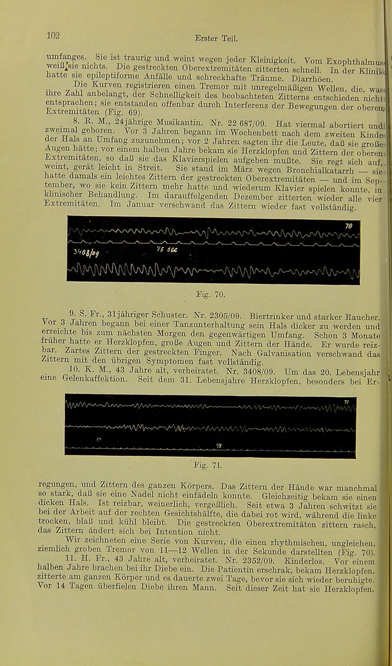 umfanges._ Sie ist traurig und weint wegen jeder Kleinigkeit. Vom Exophthalmic weiB^sie nichts. Die gestreckten Oberextremitaten zitterten schnell. In der Klinik hatte sie epiloptiforme Anfalle und schreckhafte Traume. Diarrhoen <w 7 ^m'yen refistl'ieren einen Tremor mit unregelmaBigen Weflen, die, way ihre Zahl anbclangt, der Schnelligkeit des beobachteten Zitterns entschieden nicht, ESS^^S^ °ffeQbar InterferenZ d6r Beweguagen der oberenp 8. E M., 24jahrige Musikantia. Nr. 22 687/09. Hat viermal abortiert undl zweirnal geboren. Vor 3 Jahren begann im Wochenbett nach dem zweiten Kinde, der Hals an Umfang zuznnebmen; vor 2 Jahren sagten ihr die Leute, daB sie groBe-- Augen hatte; vor einem halben Jahre bekam sie Herzklopfen nnd Zittern der oberem Jixtremitaten, so daB sie das Klavierspielen aufgeben mnBte. Sie regt sich auf weint gerat leicht in Streit. Sie stand im Marz wegen Bronchialkatarrh — sie- hatte damals em leichtes Zittern der gestreckten Oberextremitaten — und im Sep tember, wo sie kein Zittern mehr hatte und wiederum Klavier spielen konnte in khmscher Behandlung. Im darauffolgenden Dezember zitterten wieder alle vier Extremitaten. Im Januar verschwand das Zittern wieder fast vollstandi°- '/s ie* JVaA/\)V\[^vvv Fig. 70. 9 S. Pr., 31jahriger Schuster. Nr. 2305/09. Biertrinker und starker Eaucher. Vor 3 Jahren begann bei einer Tanzunterhaltung sein Hals dicker zu werden und erreichte bis zum nachsten Morgen den gegenwartigen Umfang. Schon 3 Monate truner hatte er Herzklopfen, groBe Augen und Zittern der Hande. Er wurde reiz- bar Zartes Zittern der gestreckten Finger. Nach Galvanisation verschwand das Zittern mit den iibrigen Symptomen fast vollstandig. 10. K. M., 43 Jahre alt, verheiratet. Nr. 3408/09. Urn das 20. Lebensjahr' eme Gelenkaffektion. Seit dem 31. Lebensjahre Herzklopfen, besonders bei Er-i Pig. 71. regungen, und Zittern des ganzen Korpers. Das Zittern der Hande war manchmal so stark daB sie erne Nadel nicht einfadeln konnte. Gleichzeitig bekam sie einen dicken Hals. Ist reizbar, weinerlich, vergeBlich. Seit etwa 3 Jahren schwitzt sie bei der Arbeit auf der rechten Gesichtshalfte, die dabei rot wird, wahrend die linke trocken, blaB und kiihl bleibt. Die gestreckten Oberextremitaten zittern rasch. das Zittern andert sich bei Intention nicht. Wir zeichneten eine Serie von Kurven, die einen rhythmischen, un°-leichen, ziemlich groben Tremor von 11—12 Wellen in der Sekimde darstellten (Pig. 70). 11. H. Pr., 43 Jahre alt, verheiratet. Nr. 2352/09. Kinderlos. Vor einem halben Jahre brachen bei ihr Diebe ein. Die Patientiu erschrak, bekam Herzklopfen. zitterte am ganzen Korper und es dauerte zwei Tage, bevor sie sich wieder beruhi^te. Vor 14 Tagen iiberfielen Diebe ihren Mann. Seit dieser Zeit hat sie Herzklopfen,