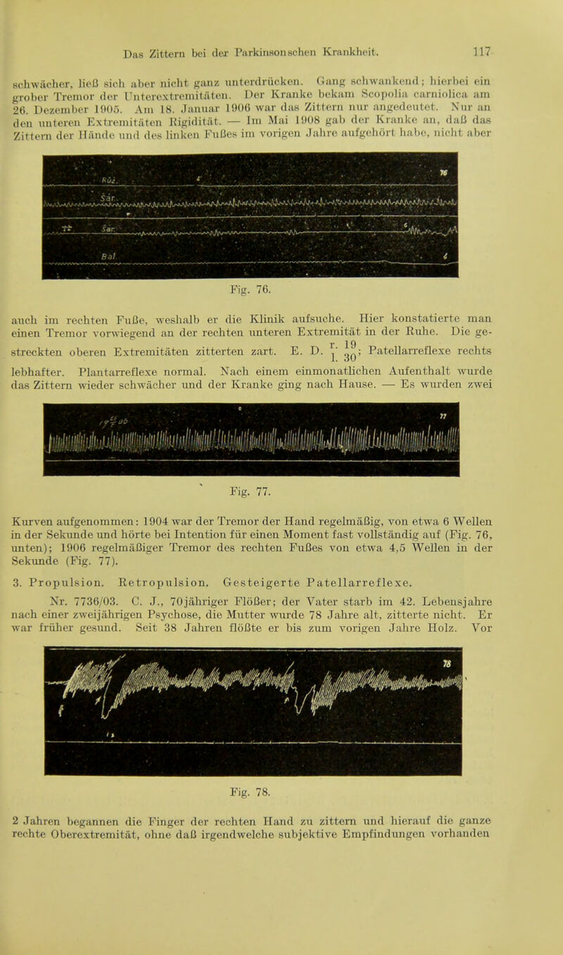 schwaeher, liefi sieh aber nicht ganz unterdriieken. Cang s.-liwank.-iul; hierbei ein grober Tremor dor I'nteroxtroiiiitateii. Der Kranke bekam Scopolia carniolica am 20. Dczember l!»(»5. Am 18. .laiiuar 1906 war <las Ziltcni atll angedeutet. tfui BO den unteren Extremitaten Rigiditat, — Im Mai 1908 gab der Kranke an, dafl das Zittern der Hande und des linken Fulies im vorigen Jahre aufgehort babe, nicht aber Fig. 76. auch im rechten Fufle, weshalb er die Klinik aufsuche. Hier konstatierte man einen Tremor vorwiegend an der rechten nnteren Extremitat in der Ruhe. Die ge- r 19 streckten oberen Extremitaten zitterten zart. E. D. ' ; Patellarreflexe rechts lebhafter. Plantarreflexe normal. Nach einem einmonathchen Aufenthalt wurde das Zittern wieder schwacher und der Kranke ging nach Hause. — Es wurden zwei D n 1 I Fig. 77. Kurven aufgenommen: 1904 war der Tremor der Hand regelmaBig, von etwa 6 Wellen in der Sekunde und horte bei Intention fiir einen Moment fast vollstandig auf (Fig. 76, unten); 1906 regelmaCiger Tremor des rechten Fufies von etwa 4,5 Wellen in der Sekunde (Fig. 77). 3. Propulsion. Retropulsion. Gesteigerte Patellarreflexe. Nr. 7736/03. C. J., 70jahriger Flofler; der Vater starb im 42. Lebensjahre nach einer zweijahrigen Psychose, die Mutter wurde 78 Jahre alt, zitterte nicht. Er war fruher gesimd. Seit 38 Jahren flofJte er bis zum vorigen Jahre Holz. Vor Fig. 78. 2 Jahren begannen die Finger der rechten Hand zu zittern und hierauf die ganze rechte Oberextremitat, ohne daB irgendwelche subjektive Emj)findungen vorhanden