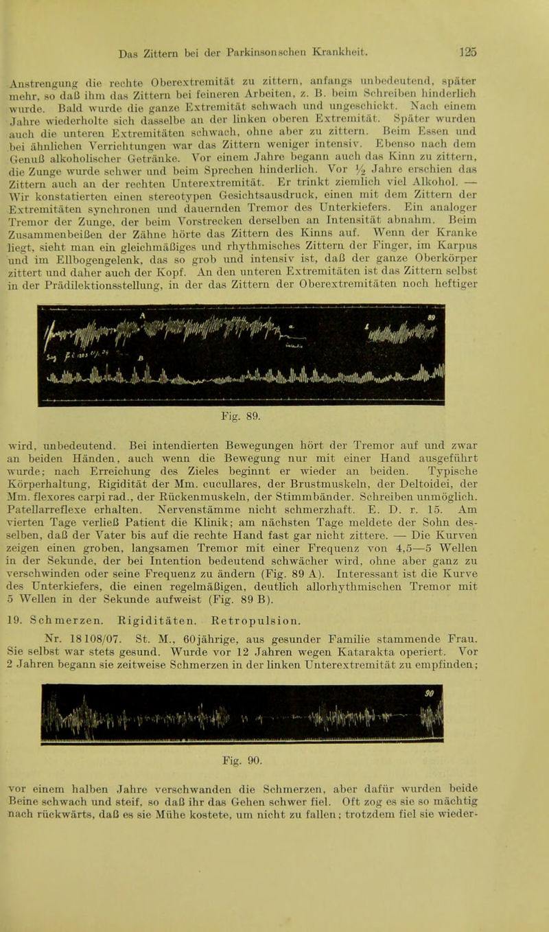 Anstrengung die reclite Oberextrcmitat zu zittern, an flings uubedeutend, spftter mehr, so daB ihm das Zittern bei feineren Arbeiten, z. B. beim Sclm il.cn liindcrlich wurde. Bald wurde die ganzo Extremitat schwach und ungeschickt. Nach einem Jahre wiedorholte sicb dasselbe an der linkon oberen Extremitat. Spiiter warden auch die unteren Extremitaten schwach, oline aber zn zittern. Beim Essen and bei ahnlicheu Verriehtungon war das Zittern weniger intensiv. Ebenso nach dem GenuB alkoholischer Getranke. Vor einem Jahre begann aacli das Ivinn zn zittern, die Zunge wurde schwer and beim Spreehen hinderlich. Vor '/2 Jahre ersehien das Zittern auch an der reehten Unterextremitat. Er trinkt ziemlich viel Alkohol. — Wir konstatierten einen stereotypen Gesichtsausdruck, einen mit dem Zittern der Extremitaten synchronen und dauernden Tremor des Unterkiefers. Ein analoger Tremor der Zunge. der beim Vorstrecken derselben an Intensitiit abnahm. Beim ZusanmienbeiBeu der Ziihne horte das Zittern des Kinns auf. Wenn der Kranke liegt, sieht man ein gleichmiiBiges und rhythmisehes Zittern der Finger, im Karpus and im Ellbogengelenk, das so grob und intensiv ist, daB der ganze Oberkorper zittert and daher auch der Kopf. An den unteren Extremitaten ist das Zittern selbst in der Pradilektionsstellung, in der das Zittern der Oberextremitaten noch heftiger wird, uubedeutend. Bei intendierten Bewegungen hort der Tremor auf und zwar an beiden Handen, auch wenn die Bewegung nur mit einer Hand ausgefiihrt wurde; nach Erreichung des Zieles beginnt er wieder an beiden. Typische Korperhaltung, Rigiditat der Mm. cucullares, der Brustmuskeln, der Deltoidei, der Mm. flexores carpi rad., der Riickenmuskeln, der Stimmbander. Schreiben unmoglich. Patellarreflexe erhalten. Nervenstamme nicht schmerzhaft. E. D. r. 15. Am vierten Tage verlieB Patient die Klinik; am nachsten Tage meldete der Sohn des- selben, daB der Vater bis auf die rechte Hand fast gar nicht zittere. — Die Kurven zeigen einen groben, langsamen Tremor mit einer Frequenz von 4,5—5 Wellen in der Sekunde, der bei Intention bedeutend schwacher wird, ohne aber ganz zu verschwinden oder seine Frequenz zu andern (Fig. 89 A). Interessant ist die Kurve des Unterkiefers, die einen regelmaBigen, deutlich allorhytlmiischen Tremor mit 5 Wellen in der Sekunde aufweist (Fig. 89 B). 19. Schmerzen. Rigiditaten. Retropulsion. Nr. 18108/07. St. M., 60jahrige, aus gesunder Familie stammende Frau. Sie selbst war stets gesund. Wurde vor 12 Jahren wegen Katarakta operiert. Vor 2 Jahren begann sie zeitweise Schmerzen in der linken Unterextremitat zu empfiuden; vor einem halben Jahre verschwanden die Schmerzen, aber dafiir wurden beide Beine schwach und steif. so daB ihr das Gehen schwer fiel. Oft zog es sie so machtig nach riickwarts, daB es sie Miihe kostete, um nicht zu fallen; trotzdem fiel sie wieder-