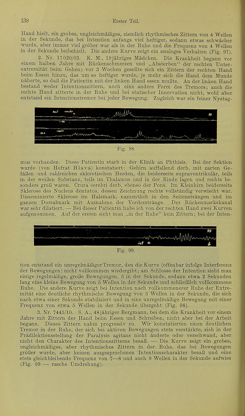 Hand hielt, ein grobes, ungleichmafliges, ziemlicb rhythmisches Zittern von 4 Wellen in der Sekunde, das bei Intention anfangs viel heftiger, sodann etwas scbwacher wurde, aber immer viel grober war als in der Rnhe und die Frequenz von 4 WelJen in der Sekunde beibehielt. Die andere Kurve zeigt ein analoges Verbalten (Fig. 97). 2. Nr. 17 020/03. K. M., 19jabriges Madchen. Die Krankbeit begann vor einem balben Jabre mit Ruckenschmerzen und ,,Absterben der recbten Unter- extremitat beim Geben; vor 3 Wocben gesellte sicb ein Zittern der recbten Hand beim Essen binzu, das urn so beftiger wurde, je mebr sicb die Hand dem Munde naberte, so daB die Patientin mit der linken Hand essen muBte. An der linken Hand bestand weder Intentionszittern, nocb eine andere Form des Tremors; aucb die recbte Hand zitterte in der Ruhe und bei statiscber Innervation nicbt, wobl aber entstand ein Intentionstremor bei jeder Bewegung. Zugleich war ein feiner Nystag- Fig. 98 mus vorbanden. Diese Patientin starb in der EJinik an Pbtbisis. Bei der Sektion wurde (von Hofrat Hlava) konstatiert: Gehirn auffallend derb, mit zarten Ge- fafien und zabLreicben sklerotiscben Herden, die beiderseits supraventrikular, teils in der weiBen Substanz, teils im Thalamus und in der Rinde lagen und recbts be- sonders groB waren. Crura cerebri derb, ebenso der Pons. Im Kleinbirn beiderseits Sklerose des Nucleus dentatus, dessen Zeicbnung recbts vollstandig verwiscbt war. Disseminierte Sklerose im Halsmark, namentlicb in den Seitenstrangen und im ganzen Dorsalmark mit Ausnabme der Vorderstrange. Der Riickenmarkskanal war sebr dilatiert. — Bei dieser Patientin babe icb von der recbten Hand zwei Kurven aufgenommen. Auf der ersten siebt man ,,in der Rube kein Zittern; bei der Inten- 99 Fie. 99. tion entstand ein unregelmaBiger Tremor, den die Kurve (offenbar infolge Interferenz der Bewegungen) nicbt vollkommen wiedergibt; am Scblusse der Intention siebt man einige regelmaBige, groBe Bewegungen, 5 in der Sekunde, sodann etwa 2 Sekunden lang eine kleine Bewegung von 5 Wellen in der Sekunde und scblieBlicb vollkommene Rube. Die andere Kurve zeigt bei Intention nacb vollkommenerer Rube der Extre- mitat eine deutlicbe rbytbmiscbe Bewegung von 5 Wellen in der Sekunde, die sicb nacb etwa einer Sekunde stabilisiert und in eine unregelmaBige Bewegung mit einer Frequenz von etwa 5 Wellen in der Sekunde iibergebt (Fig. 98). 3. Nr. 7445/10. S. A., 48jabriger Bergmann, bei dem die Krankbeit vor einem Jahre mit Zittern der Hand beim Essen und Scbreiben, nicbt aber bei der Arbeit begann. Dieses Zittern nabm progressiv zu. Wir konstatierten einen deutlichen Tremor in der Rube, der sicb bei aktiven Bewegungen stets verstarkte, sicb in der Pradilektionsstellung der Paralysis agitans nicbt anderte oder verscbwand, aber nicbt den Cbarakter des Intentionszitterns besaB. — Die Kurve zeigt ein grobes, ungleicbmaBiges, aber rhytbmiscbes Zittern in der Rube, das bei Bewegungen groBer wurde, aber keinen ausgesprocbenen Intentionscbarakter besaB und eine stets gleichbleibende Frequenz von 7—8 und aucb 9 Wellen in der Sekunde aufwies (Fig. 99 — rascbe Umdrebung).