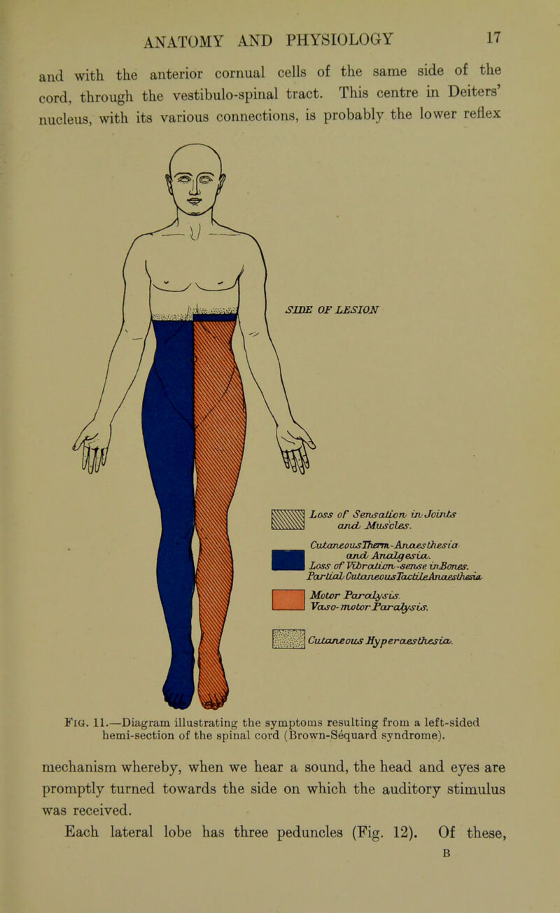 and with the anterior cornual cells of the same side of the cord, through the vestibulo-spinal tract. This centre in Deiters' nucleus, with its various connections, is probably the lower reflex SIDE OF LESION Loss oF SeTusaIix)ni uvJoinJbs and MxLs'cles. CvJjoneousTkerm.-Ancuesthesia' ajvab Analgesia^. Loss of WbroUioTh-sense iitEones. ParU/xL CvJtojvROUjsTa^tiJUAnjazsthesui, Motor Paralysis. Vase- motor JPardfysiAS. CvUaneous Hyperoteslhesijcu. Fig. 11.—Diagram illustrating the symptoms resulting from a left-sided hemi-section of the spinal cord (Brown-Sequard syndrome). mechanism whereby, when we hear a sound, the head and eyes are promptly turned towards the side on which the auditory stimulus was received. Each lateral lobe has three peduncles (Fig. 12). Of these, B