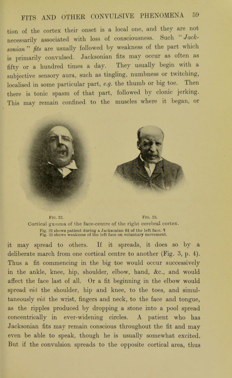 tion of the cortex their onset is a local one, and they are not necessarily associated with loss of consciousness. Such  JacA;- sonian  fits are usually followed by weakness of the part which is primarily convulsed. Jacksonian fits may occur as often as fifty or a hundred times a day. They usually begin with a subjective sensory aura, such as tingling, numbness or twitching, locaUsed in some particular part, e.g. the thumb or big toe. Then there is tonic spasm of that part, followed by clonic jerking. This may remain confined to the muscles where it began, or Fig. 22. Fig. 23. Cortical gumma of the face-centre of the right cerebral cortex. Fig. 22 shows patient during a Jacksonian fit of the left face. 1 Fig. 23 shows weakness of the left face on voluntary movement. it may spread to others. If it spreads, it does so by a dehberate march from one cortical centre to another (Fig. 3, p. 4). Thus a fit commencing in the big toe would occur successively in the ankle, knee, hip, shoulder, elbow, hand, &c., and would affect the face last of all. Or a fit beginning in the elbow would spread vid the shoulder, hip and knee, to the toes, and simul- taneously vid the wrist, fingers and neck, to the face and tongue, as the ripples produced by dropping a stone into a pool spread concentrically in ever-widening circles. A patient who has Jacksonian fits may remain conscious throughout the fit and may even be able to speak, though he is usually somewhat excited. But if the convulsion spreads to the opposite cortical area, thus