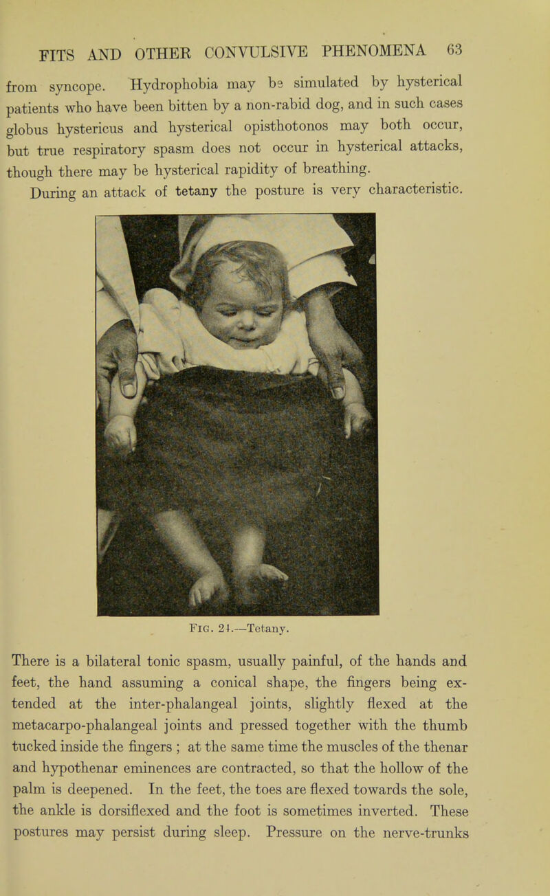 from syncope. Hydrophobia may bs simulated by hysterical patients who have been bitten by a non-rabid dog, and in such cases globus hystericus and hysterical opisthotonos may both occur, but true respiratory spasm does not occur in hysterical attacks, though there may be hysterical rapidity of breathing. During an attack of tetany the posture is very characteristic. Fig. 24.—Tetany. There is a bilateral tonic spasm, usually painful, of the hands and feet, the hand assuming a conical shape, the fingers being ex- tended at the inter-phalangeal joints, slightly flexed at the metacarpo-phalangeal joints and pressed together with the thumb tucked inside the fingers ; at the same time the muscles of the thenar and hypothenar eminences are contracted, so that the hollow of the palm is deepened. In the feet, the toes are flexed towards the sole, the ankle is dorsiflexed and the foot is sometimes inverted. These postures may persist during sleep. Pressure on the nerve-trunks