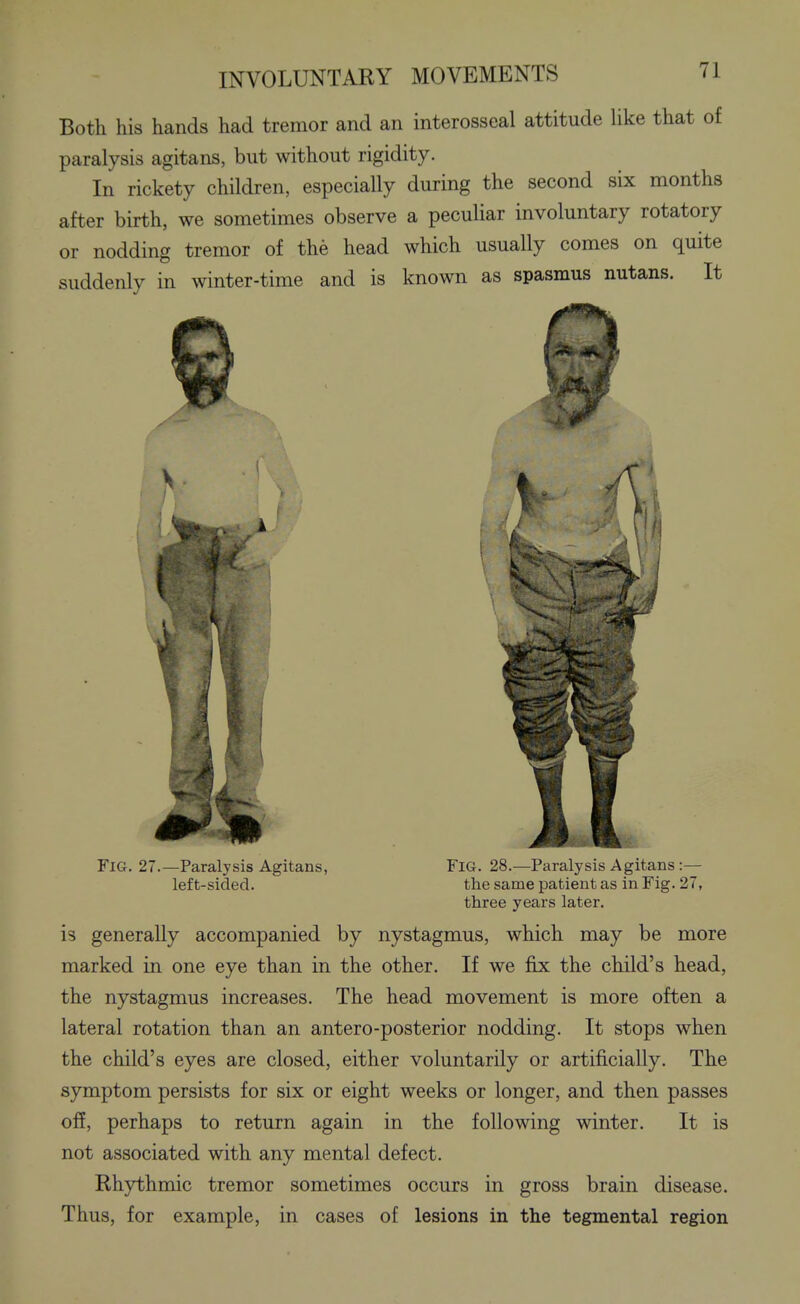 Both his hands had tremor and an interosseal attitude Uke that of paralysis agitans, but without rigidity. In rickety children, especially during the second six months after birth, we sometimes observe a peculiar involuntary rotatory or nodding tremor of the head which usually comes on quite suddenly in winter-time and is known as spasmus nutans. It left-sided. the same patient as in Fig. 27, three years later. is generally accompanied by nystagmus, which may be more marked in one eye than in the other. If we fix the child's head, the nystagmus increases. The head movement is more often a lateral rotation than an antero-posterior nodding. It stops when the child's eyes are closed, either voluntarily or artificially. The symptom persists for six or eight weeks or longer, and then passes off, perhaps to return again in the following winter. It is not associated with any mental defect. Rhythmic tremor sometimes occurs in gross brain disease. Thus, for example, in cases of lesions in the tegmental region