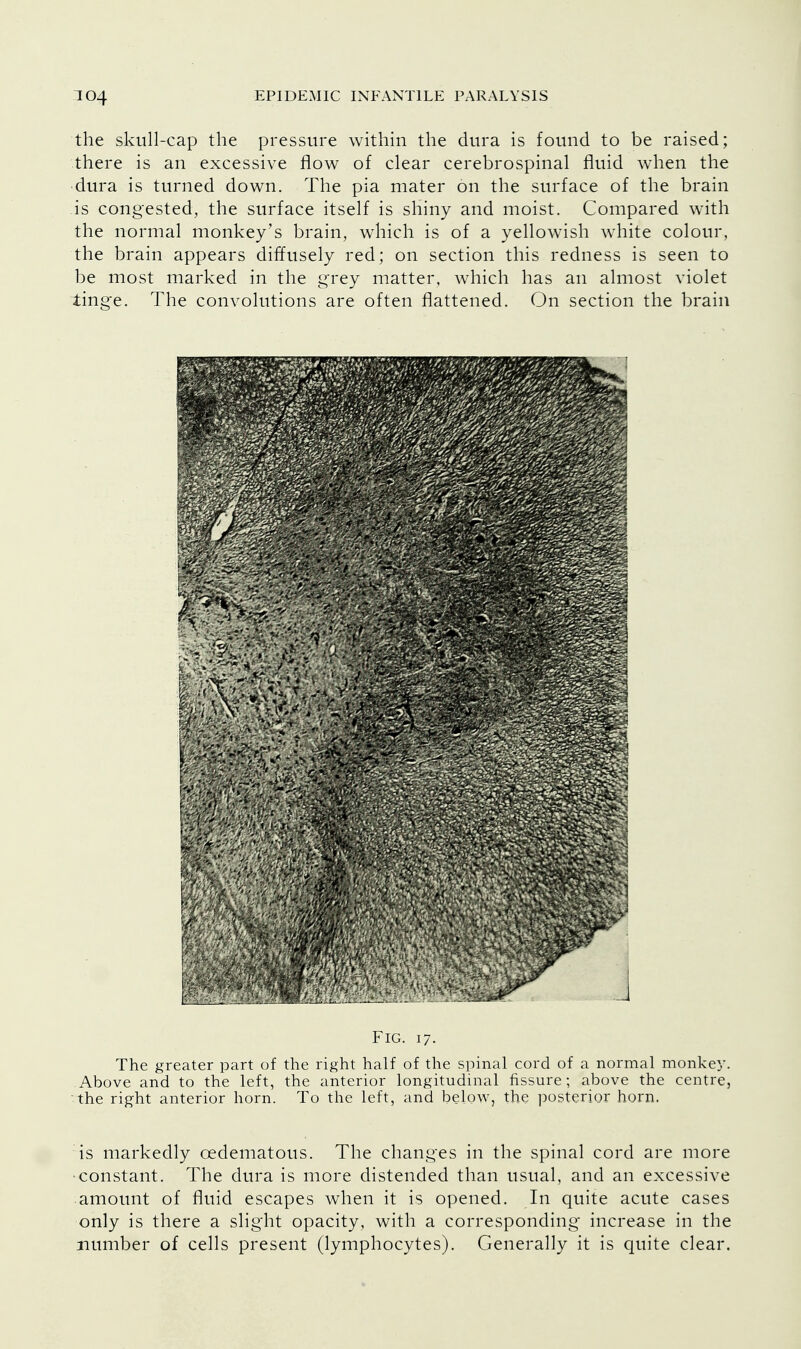 the skull-cap the pressure within the dura is found to be raised; there is an excessive flow of clear cerebrospinal fluid when the dura is turned down. The pia mater on the surface of the brain is congested, the surface itself is shiny and moist. Compared with the normal monkey's brain, which is of a yellowish white colour, the brain appears diffusely red; on section this redness is seen to be most marked in the grey matter, which has an almost violet tinge. The convolutions are often flattened. On section the brain Fig. 17. The greater part of the right half of the spinal cord of a normal monkey. Above and to the left, the anterior longitudinal fissure; above the centre, the right anterior horn. To the left, and below, the posterior horn. is markedly cedematous. The changes in the spinal cord are more •constant. The dura is more distended than usual, and an excessive amount of fluid escapes when it is opened. In quite acute cases only is there a slight opacity, with a corresponding increase in the number of cells present (lymphocytes). Generally it is quite clear.