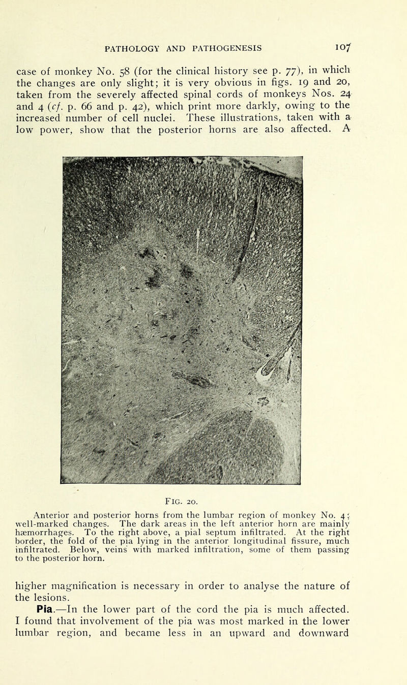 case of monkey No. 58 (for the clinical history see p. 77), in which the changes are only slight; it is very obvious in figs. 19 and 20, taken from the severely affected spinal cords of monkeys Nos. 24 and 4 (cf. p. 66 and p. 42), which print more darkly, owing to the increased number of cell nuclei. These illustrations, taken with & low power, show that the posterior horns are also affected. A Fig. 20. Anterior and posterior horns from the lumbar region of monkey No. 4; well-marked changes. The dark areas in the left anterior horn are mainly haemorrhages. To the right above, a pial septum infiltrated. At the right border, the fold of the pia lying in the anterior longitudinal fissure, much infiltrated. Below, veins with marked infiltration, some of them passing to the posterior horn. higher magnification is necessary in order to analyse the nature of the lesions. Pia.—In the lower part of the cord the pia is much affected. I found that involvement of the pia was most marked in the lower lumbar region, and became less in an upward and downward