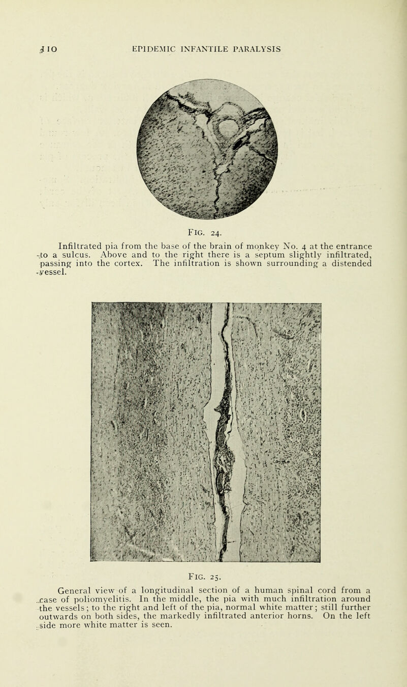 FIG. 24. Infiltrated pia from the base of the brain of monkey No. 4 at the entrance -,to a sulcus. Above and to the right there is a septum slightly infiltrated, passing into the cortex. The infiltration is shown surrounding a distended • vessel. Fig. 25. General view of a longitudinal section of a human spinal cord from a ..case of poliomyelitis. In the middle, the pia with much infiltration around the vessels; to the right and left of the pia, normal white matter; still further outwards on both sides, the markedly infiltrated anterior horns. On the left side more white matter is seen.