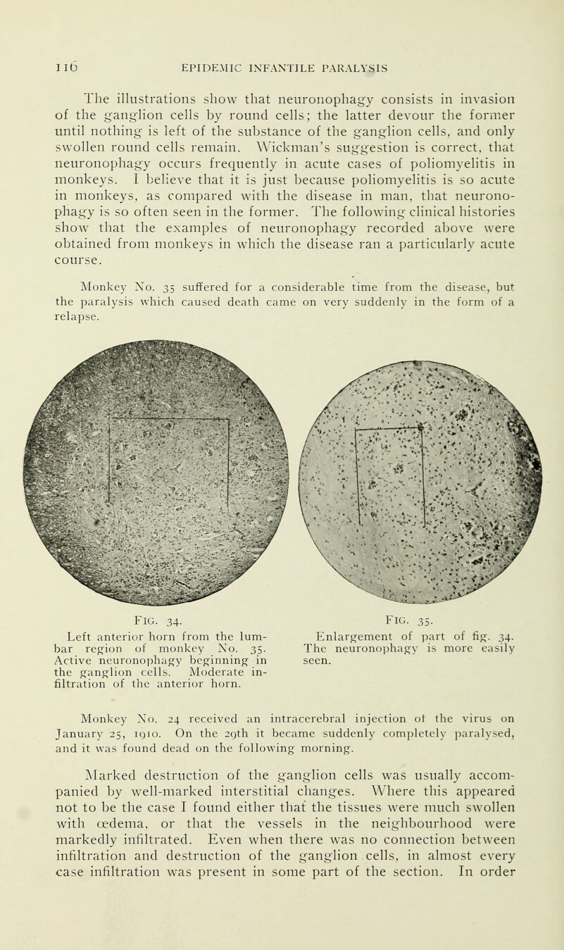 The illustrations show that neuronophagy consists in invasion of the ganglion cells by round cells; the latter devour the former until nothing is left of the substance of the ganglion cells, and only swollen round cells remain. Wickman's suggestion is correct, that neuronophagy occurs frequently in acute cases of poliomyelitis in monkeys. I believe that it is just because poliomyelitis is so acute in monkeys, as compared with the disease in man, that neurono- phagy is so often seen in the former. The following clinical histories show that the examples of neuronophagy recorded above were obtained from monkeys in which the disease ran a particularly acute course. Monkey No. 35 suffered for a considerable time from the disease, but the paralysis which caused death came on very suddenly in the form of a relapse. the gang-lion cells. Moderate in- filtration of the anterior horn. Monkey No. 24 received an intracerebral injection of the virus on January 25, icjio. On the 29th it became suddenly completely paralysed, and it was found dead on the following morning. Marked destruction of the ganglion cells was usually accom- panied by well-marked interstitial changes. Where this appeared not to be the case I found either that the tissues were much swollen with oedema, or that the vessels in the neighbourhood were markedly infiltrated. Even when there was no connection between infiltration and destruction of the ganglion cells, in almost every case infiltration was present in some part of the section. In order Left anterior horn from the lum- bar region of monkey No. 35. Active neuronophagy beginning in FIG. 34- FIG. 35. Enlargement of part of fig. 34. The neuronophagy is more easily seen.