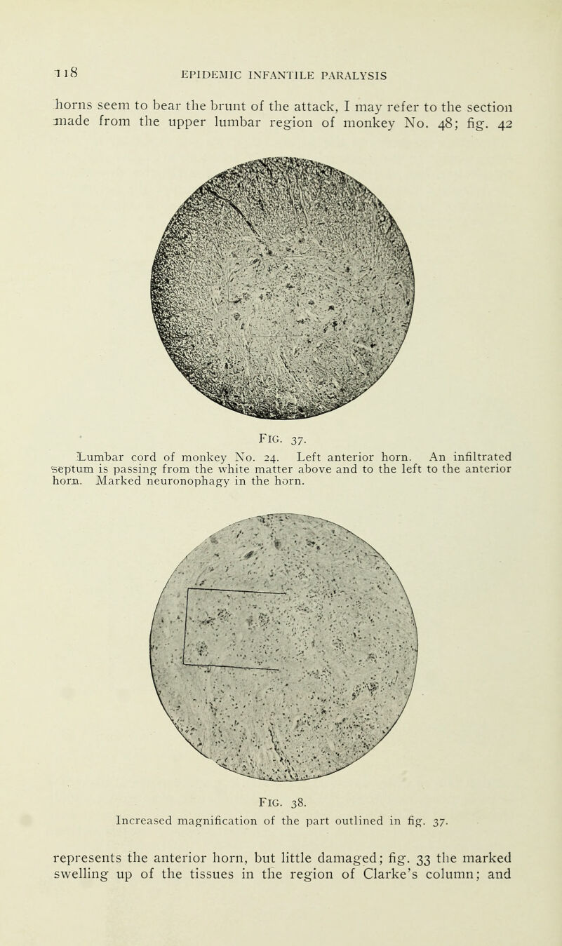 horns seem to bear the brunt of the attack, I may refer to the section made from the upper lumbar region of monkey No. 48; fig. 42 Fig. 37. •Lumbar cord of monkey No. 24. Left anterior horn. An infiltrated septum is passing- from the white matter above and to the left to the anterior horn. Marked neuronophagy in the horn. Fig. 38. Increased magnification of the part outlined in fig. 37. represents the anterior horn, but little damaged; fig. 33 the marked swelling up of the tissues in the region of Clarke's column; and
