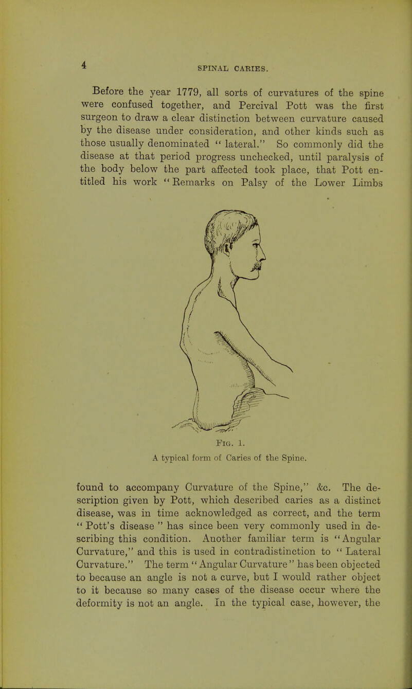 SPINAL CARIES. Before the year 1779, all sorts of curvatures of the spine were confused together, and Percival Pott was the first surgeon to draw a clear distinction between curvature caused by the disease under consideration, and other kinds such as those usually denominated  lateral. So commonly did the disease at that period progress unchecked, until paralysis of the body below the part affected took place, that Pott en- titled his work  Eemarks on Palsy of the Lower Limbs Pig. 1. A typical form of Caries of the Spine. found to accompany Curvature of the Spine, &c. The de- scription given by Pott, which described caries as a distinct disease, was in time acknowledged as correct, and the term  Pott's disease  has since been very commonly used in de- scribing this condition. Another familiar term is Angular Curvature, and this is used in contradistinction to  Lateral Curvature. The term  Angular Curvature  has been objected to because an angle is not a curve, but I would rather object to it because so many cases of the disease occur where the deformity is not an angle. In the typical case, however, the