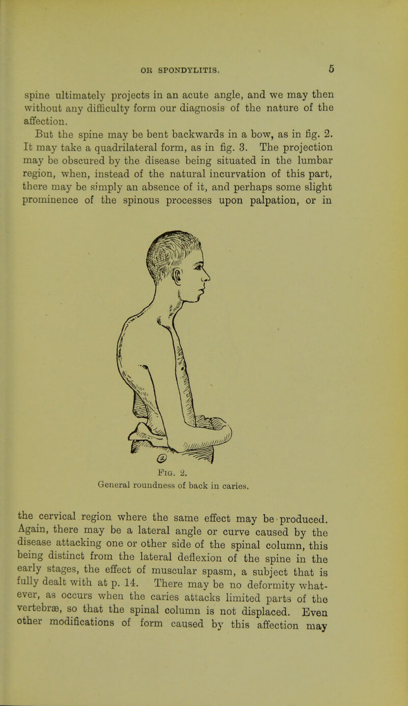 spine ultimately projects in an acute angle, and we may then without any difficulty form our diagnosis of the nature of the affection. But the spine may be bent backwards in a bow, as in fig. 2. It may take a quadrilateral form, as in fig. 3. The projection may be obscured by the disease being situated in the lumbar region, when, instead of the natural incurvation of this part, there may be simply an absence of it, and perhaps some slight prominence of the spinous processes upon palpation, or in Fig. 2. General roundness of back in caries. the cervical region where the same effect may be produced. Again, there may be a lateral angle or curve caused by the disease attacking one or other side of the spinal column, this being distinct from the lateral deflexion of the spine in the early stages, the effect of muscular spasm, a subject that is fully dealt with at p. 14. There may be no deformity what- ever, as occurs when the caries attacks limited parts of the vertebras, so that the spinal column is not displaced. Even other modifications of form caused by this affection may