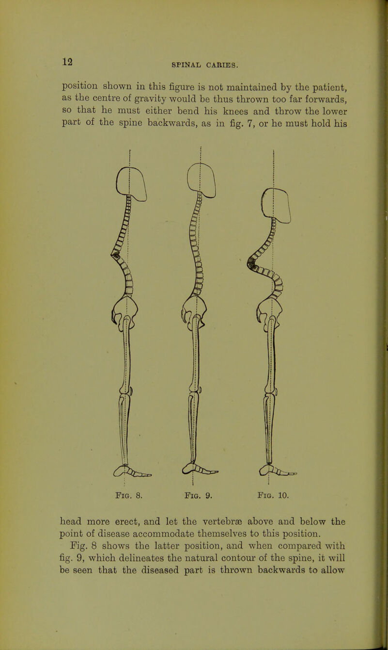 SPINAL CABIES. position shown in this figure is not maintained by the patient, as the centre of gravity would be thus thrown too far forwards, so that he must either bend his knees and throw the lower part of the spine backwards, as in fig. 7, or he must hold his Fig. 8. Fig. 9. Fig. 10. head more erect, and let the vertebrae above and below the point of disease accommodate themselves to this position. Fig. 8 shows the latter position, and when compared with fig. 9, which delineates the natural contour of the spine, it will be seen that the diseased part is thrown backwards to allow