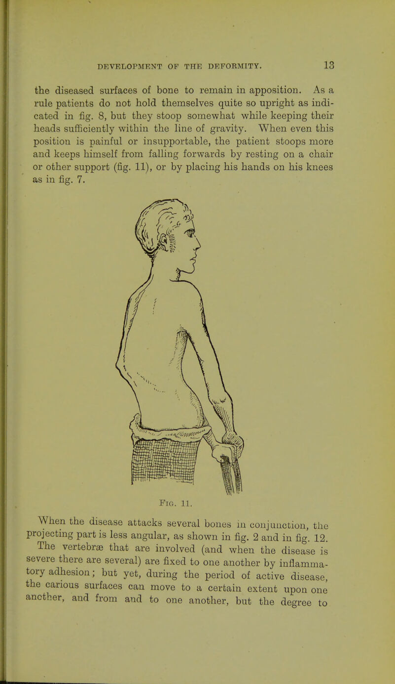 the diseased surfaces of bone to remain in apposition. As a rule patients do not hold themselves quite so upright as indi- cated in fig. 8, but they stoop somewhat while keeping their heads sufficiently within the line of gravity. When even this position is painful or insupportable, the patient stoops more and keeps himself from falling forwards by resting on a chair or other support (fig. 11), or by placing his hands on his knees as in fig. 7. When the disease attacks several bones in conjunction, the projecting part is less angular, as shown in fig. 2 and in fig. 12. The vertebras that are involved (and when the disease is severe there are several) are fixed to one another by inflamma- tory adhesion; but yet, during the period of active disease, the carious surfaces can move to a certain extent upon one another, and from and to one another, but the degree to Fig. 11.