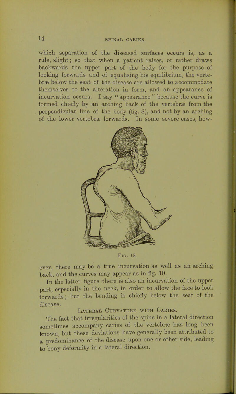 which separation of the diseased surfaces occurs is, as a rule, slight; so that when a patient raises, or rather draws backwards the upper part of the body for the purpose of looking forwards and of equalising his equilibrium, the verte- brae below the seat of the disease are allowed to accommodate themselves to the alteration in form, and an appearance of incurvation occurs. I say  appearance  because the curve is formed chiefly by an arching back of the vertebras from the perpendicular line of the body (fig. 8), and not by an arching of the lower vertebrae forwards. In some severe cases, how- Fig. 12. ever, there may be a true incurvation as well as an arching back, and the curves may appear as in fig. 10. In the latter figure there is also an incurvation of the upper part, especially in the neck, in order to allow the face to look forwards; but the bending is chiefly below the seat of the disease. Lateral Curvature with Caries. The fact that irregularities of the spine in a lateral direction sometimes accompany caries of the vertebrae has long been known, but these deviations have generally been attributed to a predominance of the disease upon one or other side, leading to bony deformity in a lateral direction.