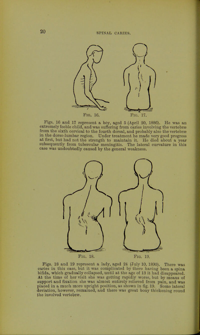 SPINAL CARIES. Fig. 16. Fig. 17. Figs. 16 and 17 represent a boy, aged 5 (April 20, 1886). He was an extremely feeble cbild, and was suffering from caries involving tbe vertebrae from tbe sixtb cervical to tbe fourth dorsal, and probably also tbe vertebras in tbe dorso-lumbar region. Under treatment be made very good progress at first, but bad not tbe strength to maintain it. He died about a year subsequently from tubercular meningitis. Tbe lateral curvature in this case was undoubtedly caused by the general weakness. Fig. 18. Fig. 19. Figs. 18 and 19 represent a lady, aged 24 (July 10, 1890). There was caries in this case, but it was complicated by there having been a spina bifida, which gradually collapsed, until at tbe age of 13 it had disappeared. At the time of her visit she was getting rapidly worse, but by means of support and fixation she was almost entirely relieved from pain, and was placed in a much more upright position, as shown in fig. 19. Some lateral deviation, however, remained, and there was great bony thickening round the involved vertebras.