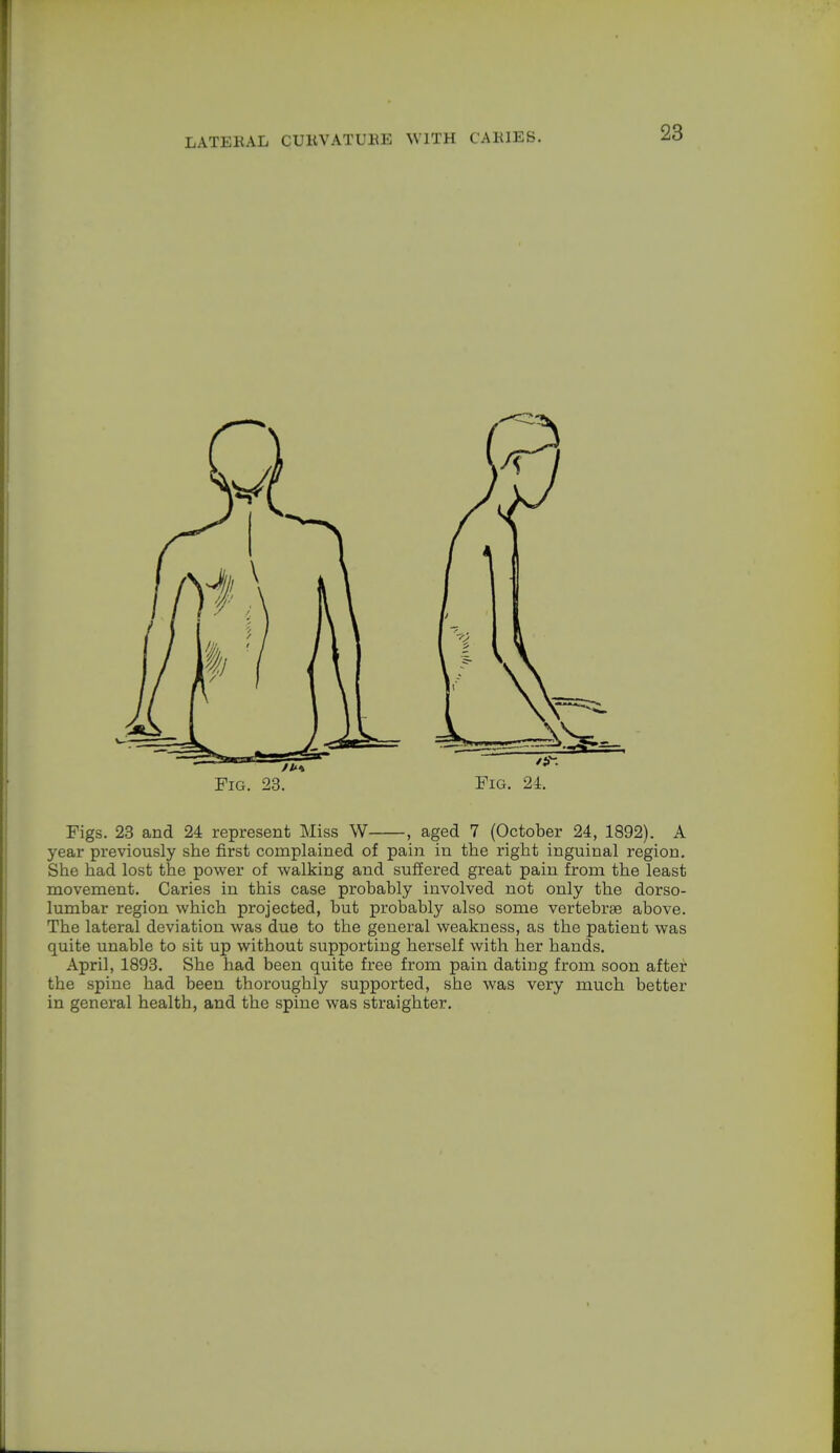 Fig. 23. Fig. 24. Figs. 23 and 24 represent Miss W , aged 7 (October 24, 1892). A year previously she first complained of pain in the right inguinal region. She had lost the power of walking and suffered great pain from the least movement. Caries in this case probably involved not only the dorso- lumbar region which projected, but probably also some vertebrae above. The lateral deviation was due to the general weakness, as the patient was quite unable to sit up without supporting herself with her hands. April, 1893. She had been quite free from pain dating from soon after the spine had been thoroughly supported, she was very much better in general health, and the spine was straighter.