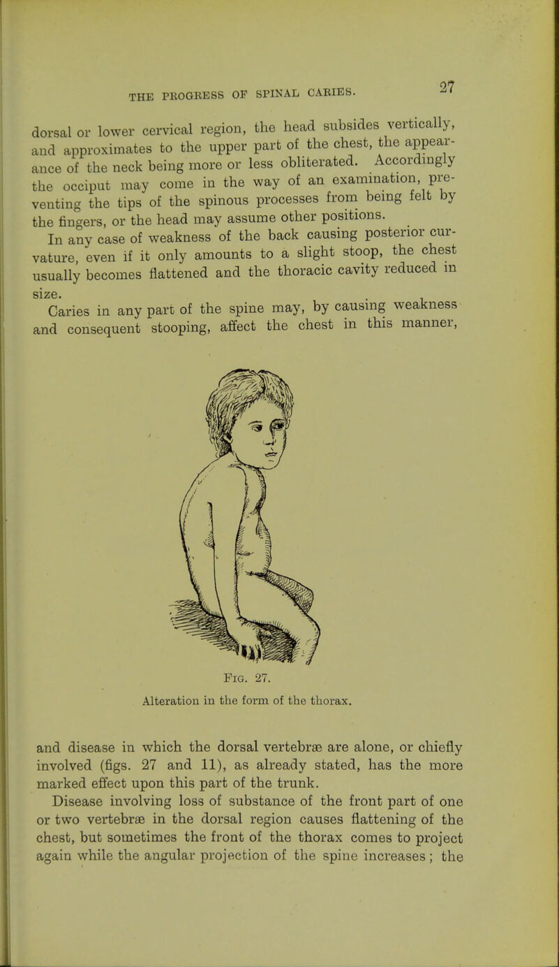 dorsal or lower cervical region, the head subsides vertically, and approximates to the upper part of the chest, the appear- ance of the neck being more or less obliterated. Accordingly the occiput may come in the way of an examination pre- venting the tips of the spinous processes from being felt by the fingers, or the head may assume other positions. In any case of weakness of the back causing posterior cur- vature, even if it only amounts to a slight stoop, the chest usually becomes flattened and the thoracic cavity reduced m size. Caries in any part of the spine may, by causing weakness and consequent stooping, affect the chest in this manner, Pig. 27. Alteration in the form of the thorax. and disease in which the dorsal vertebrae are alone, or chiefly involved (figs. 27 and 11), as already stated, has the more marked effect upon this part of the trunk. Disease involving loss of substance of the front part of one or two vertebrae in the dorsal region causes flattening of the chest, but sometimes the front of the thorax comes to project again while the angular projection of the spine increases; the