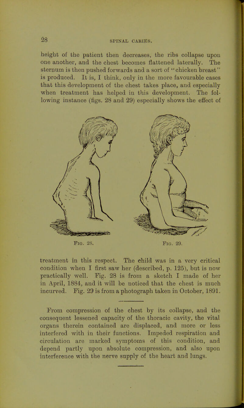 height of the patient then decreases, the ribs collapse upon one another, and the chest becomes flattened laterally. The sternum is then pushed forwards and a sort of chicken breast is produced. It is, I think, only in the more favourable cases that this development of the chest takes place, and especially when treatment has helped in this development. The fol- lowing instance (figs. 28 and 29) especially shows the effect of treatment in this respect. The child was in a very critical condition when I first saw her (described, p. 125), but is now practically well. Fig. 28 is from a sketch I made of her in April, 1884, and it will be noticed that the chest is much incurved. Fig. 29 is from a photograph taken in October, 1891. From compression of the chest by its collapse, and the consequent lessened capacity of the thoracic cavity, the vital organs therein contained are displaced, and more or less interfered with in their functions. Impeded respiration and circulation are marked symptoms of this condition, and depend partly upon absolute compression, and also upon interference with the nerve supply of the heart and lungs.