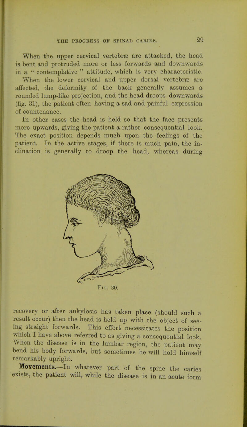 When the upper cervical vertebrae are attacked, the head is bent and protruded more or less forwards and downwards in a  contemplative  attitude, which is very characteristic. When the lower cervical and upper dorsal vertebrae are affected, the deformity of the back generally assumes a rounded lump-like projection, and the head droops downwards (fig. 31), the patient often having a sad and painful expression of countenance. In other cases the head is held so that the face presents more upwards, giving the patient a rather consequential look. The exact position depends much upon the feelings of the patient. In the active stages, if there is much pain, the in- clination is generally to droop the head, whereas during recovery or after ankylosis has taken place (should such a result occur) then the head is held up with the object of see- ing straight forwards. This effort necessitates the position which I have above referred to as giving a consequential look. When the disease is in the lumbar region, the patient may bend his body forwards, but sometimes he will hold himself remarkably upright. Movements—In whatever part of the spine the caries exists, the patient will, while the disease is in an acute form