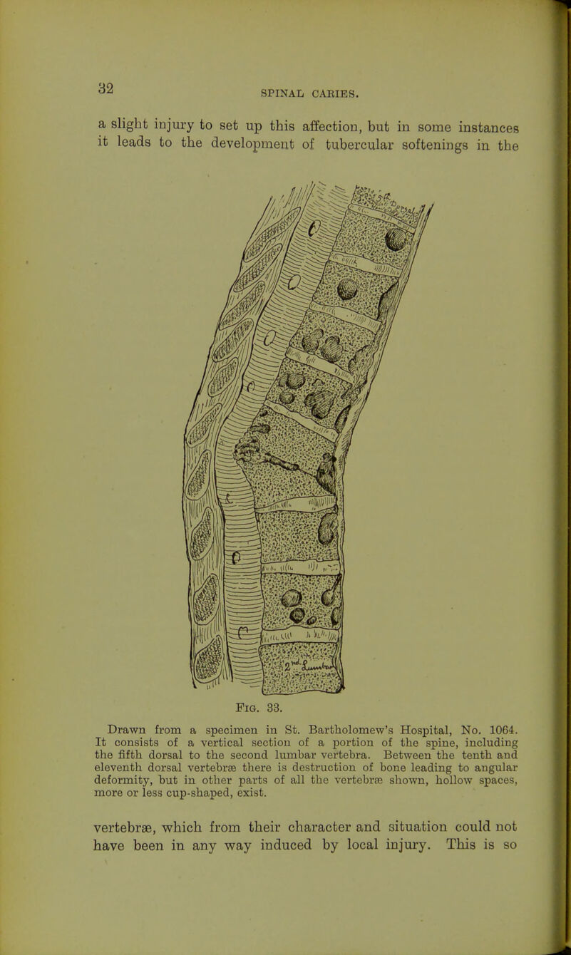 SPINAL CAKIES. a slight injury to set up this affection, but in some instances it leads to the development of tubercular softenings in the Drawn from a specimen in St. Bartholomew's Hospital, No. 1064. It consists of a vertical section of a portion of the spine, including the fifth dorsal to the second lumbar vertebra. Between the tenth and eleventh dorsal vertebrae there is destruction of bone leading to angular deformity, but in other parts of all the vertebrae shown, hollow spaces, more or less cup-shaped, exist. vertebrae, which from their character and situation could not have been in any way induced by local injury. This is so