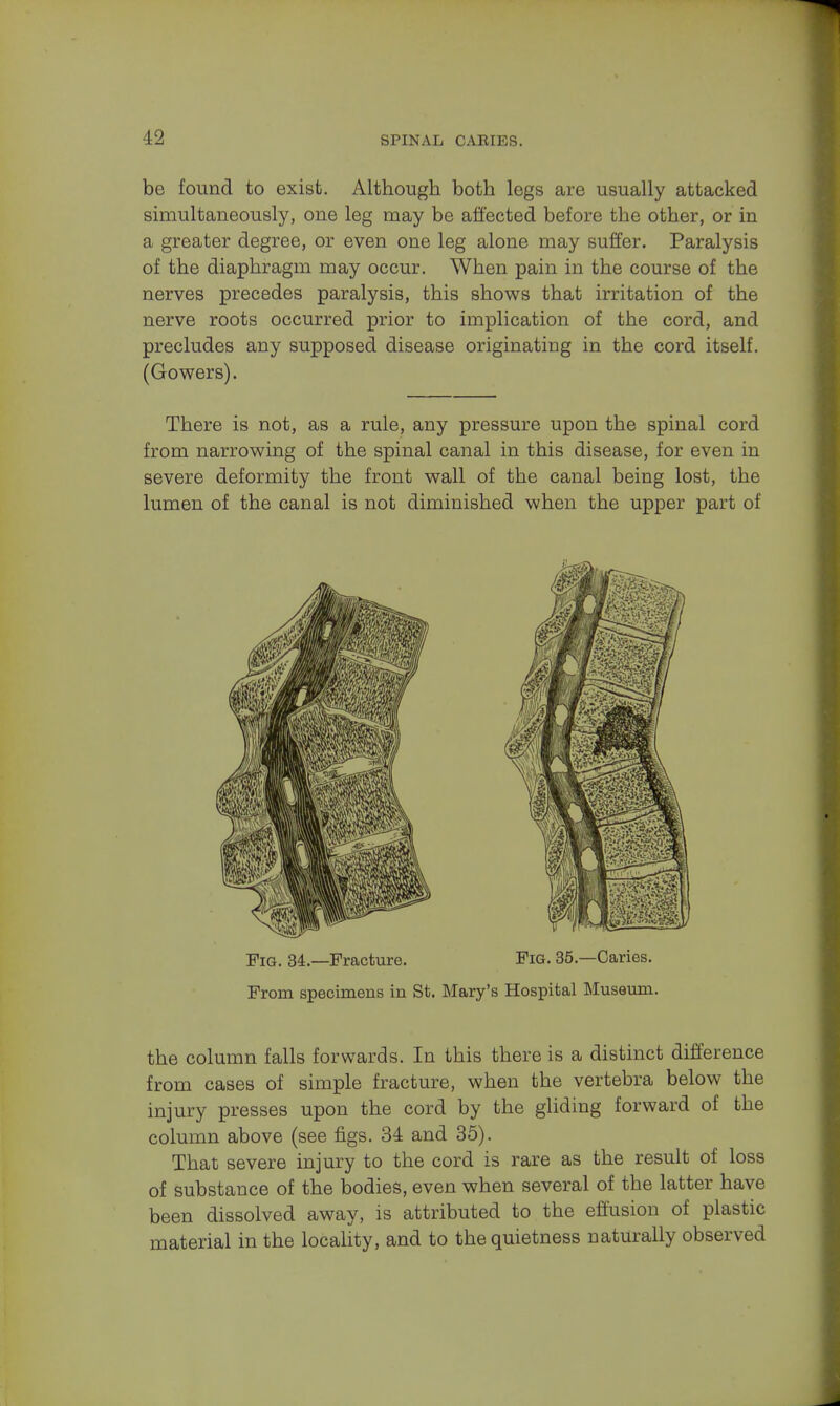 be found to exist. Although both legs are usually attacked simultaneously, one leg may be affected before the other, or in a greater degree, or even one leg alone may suffer. Paralysis of the diaphragm may occur. When pain in the course of the nerves precedes paralysis, this shows that irritation of the nerve roots occurred prior to implication of the cord, and precludes any supposed disease originating in the cord itself. (Gowers). There is not, as a rule, any pressure upon the spinal cord from narrowing of the spinal canal in this disease, for even in severe deformity the front wall of the canal being lost, the lumen of the canal is not diminished when the upper part of the column falls forwards. In this there is a distinct difference from cases of simple fracture, when the vertebra below the injury presses upon the cord by the gliding forward of the column above (see figs. 34 and 35). That severe injury to the cord is rare as the result of loss of substance of the bodies, even when several of the latter have been dissolved away, is attributed to the effusion of plastic material in the locality, and to the quietness naturally observed