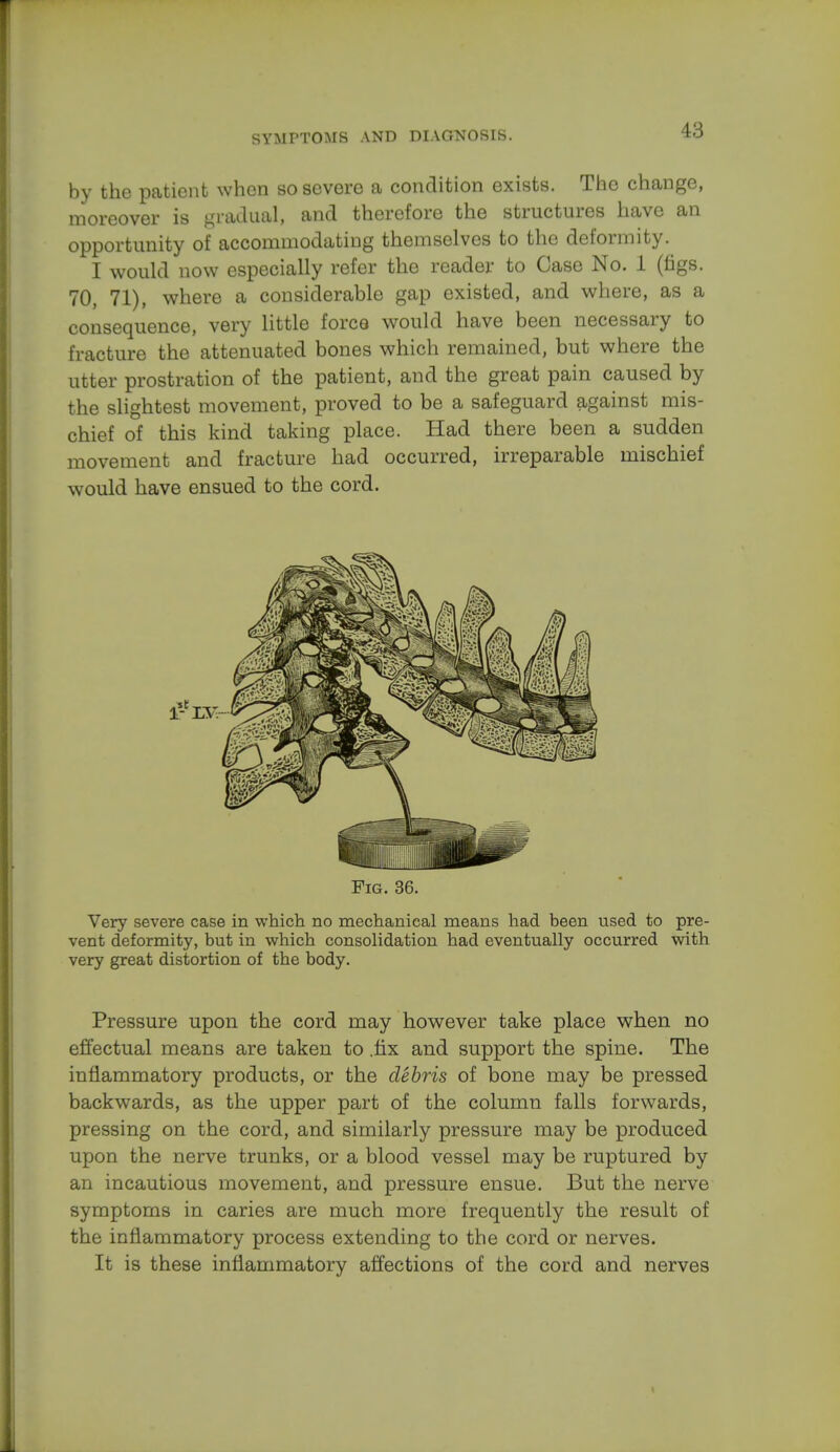 by the patient when so severe a condition exists. The change, moreover is gradual, and therefore the structures have an opportunity of accommodating themselves to the deformity. I would now especially refer the reader to Case No. 1 (figs. 70, 71), where a considerable gap existed, and where, as a consequence, very little force would have been necessary to fracture the attenuated bones which remained, but where the utter prostration of the patient, and the great pain caused by the slightest movement, proved to be a safeguard against mis- chief of this kind taking place. Had there been a sudden movement and fracture had occurred, irreparable mischief would have ensued to the cord. Fig. 36. Very severe case in which no mechanical means had been used to pre- vent deformity, but in which consolidation had eventually occurred with very great distortion of the body. Pressure upon the cord may however take place when no effectual means are taken to .fix and support the spine. The inflammatory products, or the debris of bone may be pressed backwards, as the upper part of the column falls forwards, pressing on the cord, and similarly pressure may be produced upon the nerve trunks, or a blood vessel may be ruptured by an incautious movement, and pressure ensue. But the nerve symptoms in caries are much more frequently the result of the inflammatory process extending to the cord or nerves. It is these inflammatory affections of the cord and nerves