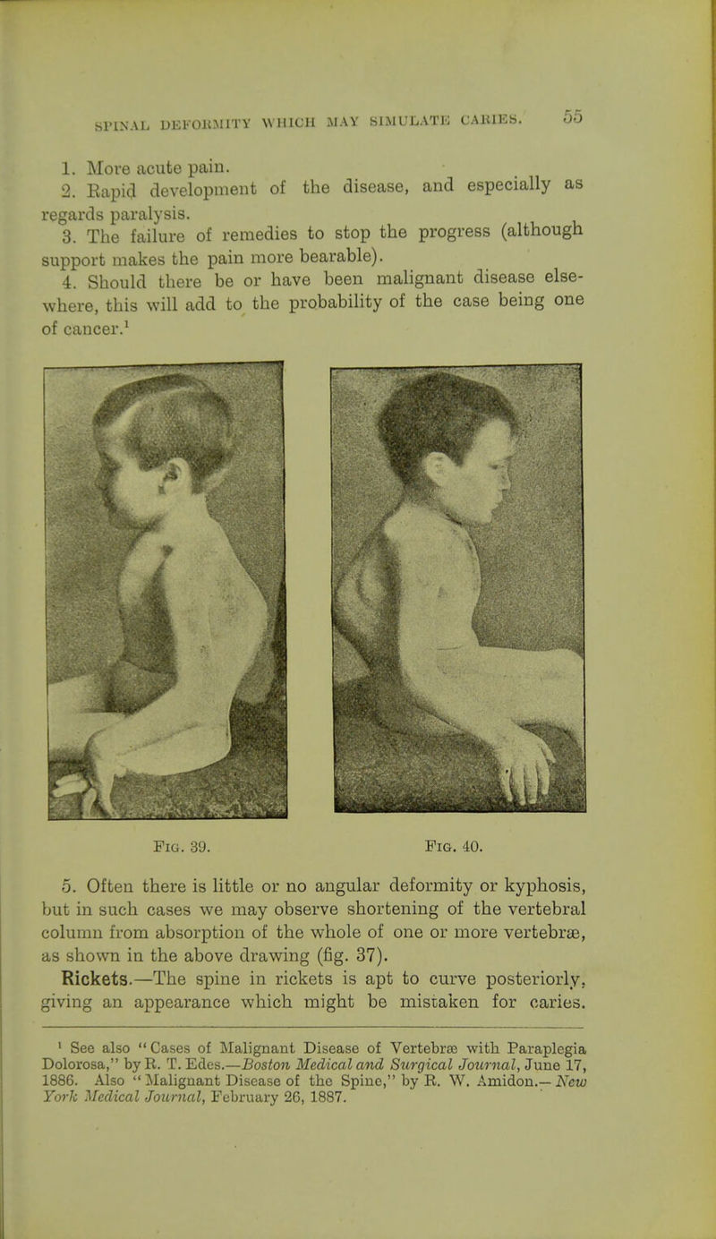 1. More acute pain. 2. Rapid development of the disease, and especially as regards paralysis. 3. The failure of remedies to stop the progress (although support makes the pain more bearable). 4. Should there be or have been malignant disease else- where, this will add to the probability of the case being one of cancer.1 Fig. 39. Fig. 40. 5. Often there is little or no angular deformity or kyphosis, but in such cases we may observe shortening of the vertebral column from absorption of the whole of one or more vertebras, as shown in the above drawing (fig. 37). Rickets.—The spine in rickets is apt to curve posteriorly, giving an appearance which might be mistaken for caries. 1 See also  Cases of Malignant Disease of Vertebne with. Paraplegia Dolorosa, by R. T. Edes.—Boston Medical and Surgical Journal, June 17, 1886. Also  Malignant Disease of the Spine, by R. W. Amidon.— New York Medical Journal, February 26, 1887.