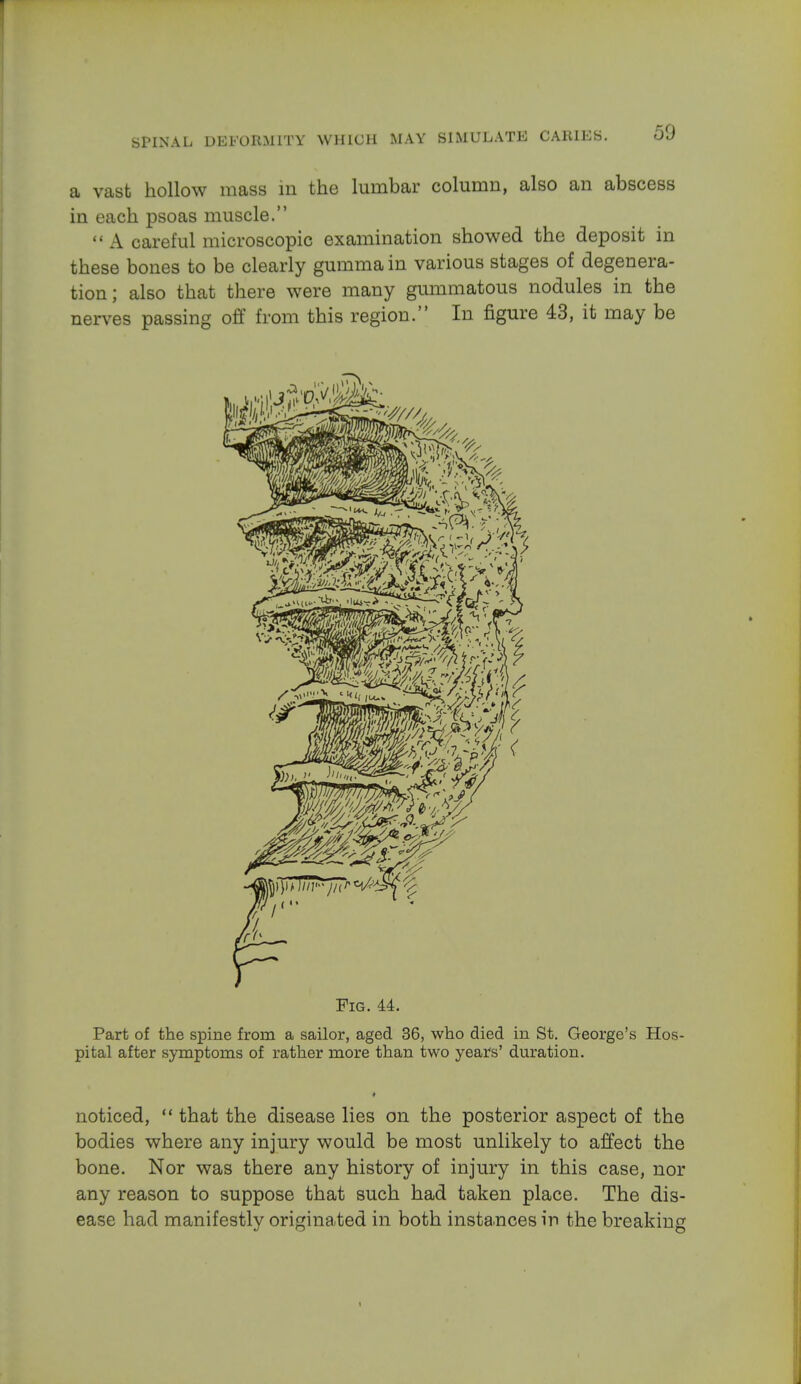 a vast hollow mass in the lumbar column, also an abscess in each psoas muscle.  A careful microscopic examination showed the deposit in these bones to be clearly gumma in various stages of degenera- tion; also that there were many gummatous nodules in the nerves passing off from this region. In figure 43, it may be Fig. 44. Part of the spine from a sailor, aged 36, who died in St. George's Hos- pital after symptoms of rather more than two years' duration. noticed,  that the disease lies on the posterior aspect of the bodies where any injury would be most unlikely to affect the bone. Nor was there any history of injury in this case, nor any reason to suppose that such had taken place. The dis- ease had manifestly originated in both instances in the breaking