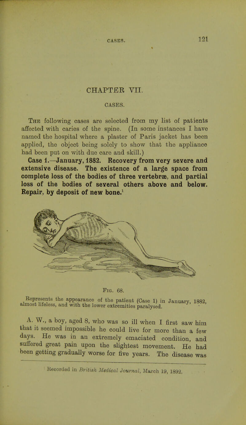 CHAPTER VII. CASES. The following cases are selected from my list of patients affected with caries of the spine. (In some instances I have named the hospital where a plaster of Paris jacket has been applied, the object being solely to show that the appliance had been put on with due care and skill.) Case 1.—January, 1882. Recovery from very severe and extensive disease. The existence of a large space from complete loss of the bodies of three vertebrae, and partial loss of the bodies of several others above and below. Repair, by deposit of new bone.1 Fig. 68. Represents the appearance of the patient (Case 1) in January, 1882, almost lifeless, and with the lower extremities paralysed. ' A. W., a boy, aged 8, who was so ill when I first saw him that it seemed impossible he could live for more than a few days. He was in an extremely emaciated condition, and suffered great pain upon the slightest movement. He had been getting gradually worse for five years. The disease was Recorded in British Medical Journal, March 19, 1892.