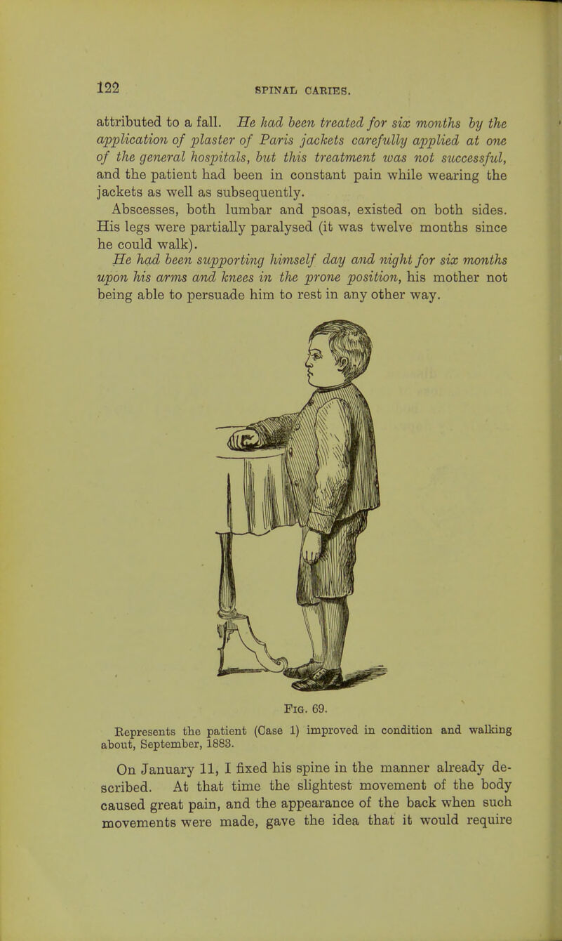 attributed to a fall. He had been treated for six months by the application of plaster of Paris jackets carefully applied at one of the general hospitals, but this treatment was not successful, and the patient had been in constant pain while wearing the jackets as well as subsequently. Abscesses, both lumbar and psoas, existed on both sides. His legs were partially paralysed (it was twelve months since he could walk). He had been supporting himself day and night for six months upon his arms and knees in the prone position, his mother not being able to persuade him to rest in any other way. Fig. 69. Bepresents the patient (Case 1) improved in condition and walking about, September, 1883. On January 11, I fixed his spine in the manner already de- scribed. At that time the slightest movement of the body caused great pain, and the appearance of the back when such movements were made, gave the idea that it would require