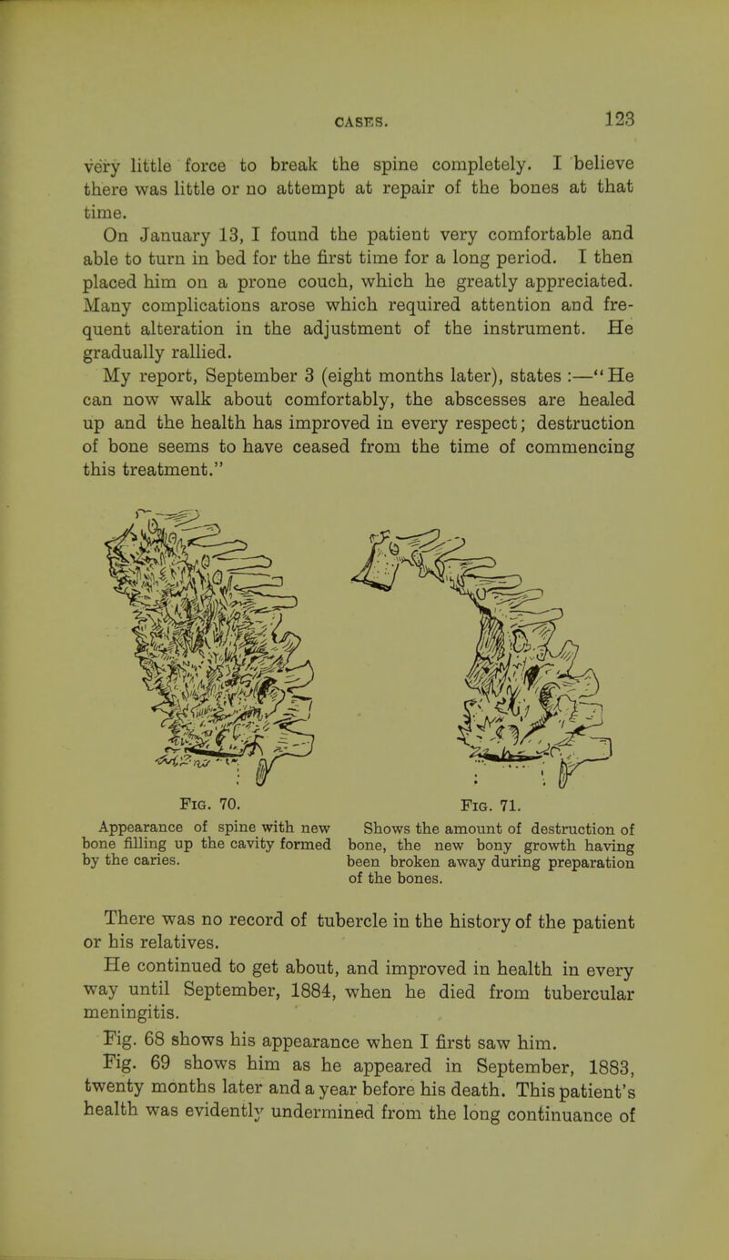 very little force to break the spine completely. I believe there was little or no attempt at repair of the bones at that time. On January 13, I found the patient very comfortable and able to turn in bed for the first time for a long period. I then placed him on a prone couch, which he greatly appreciated. Many complications arose which required attention and fre- quent alteration in the adjustment of the instrument. He gradually rallied. My report, September 3 (eight months later), states :—He can now walk about comfortably, the abscesses are healed up and the health has improved in every respect; destruction of bone seems to have ceased from the time of commencing this treatment. Fig. 70. Fig. 71. Appearance of spine with new Shows the amount of destruction of bone filling up the cavity formed bone, the new bony growth having by the caries. been broken away during preparation of the bones. There was no record of tubercle in the history of the patient or his relatives. He continued to get about, and improved in health in every way until September, 1884, when he died from tubercular meningitis. Fig. 68 shows his appearance when I first saw him. Fig. 69 shows him as he appeared in September, 1883, twenty months later and a year before his death. This patient's health was evidently undermined from the long continuance of
