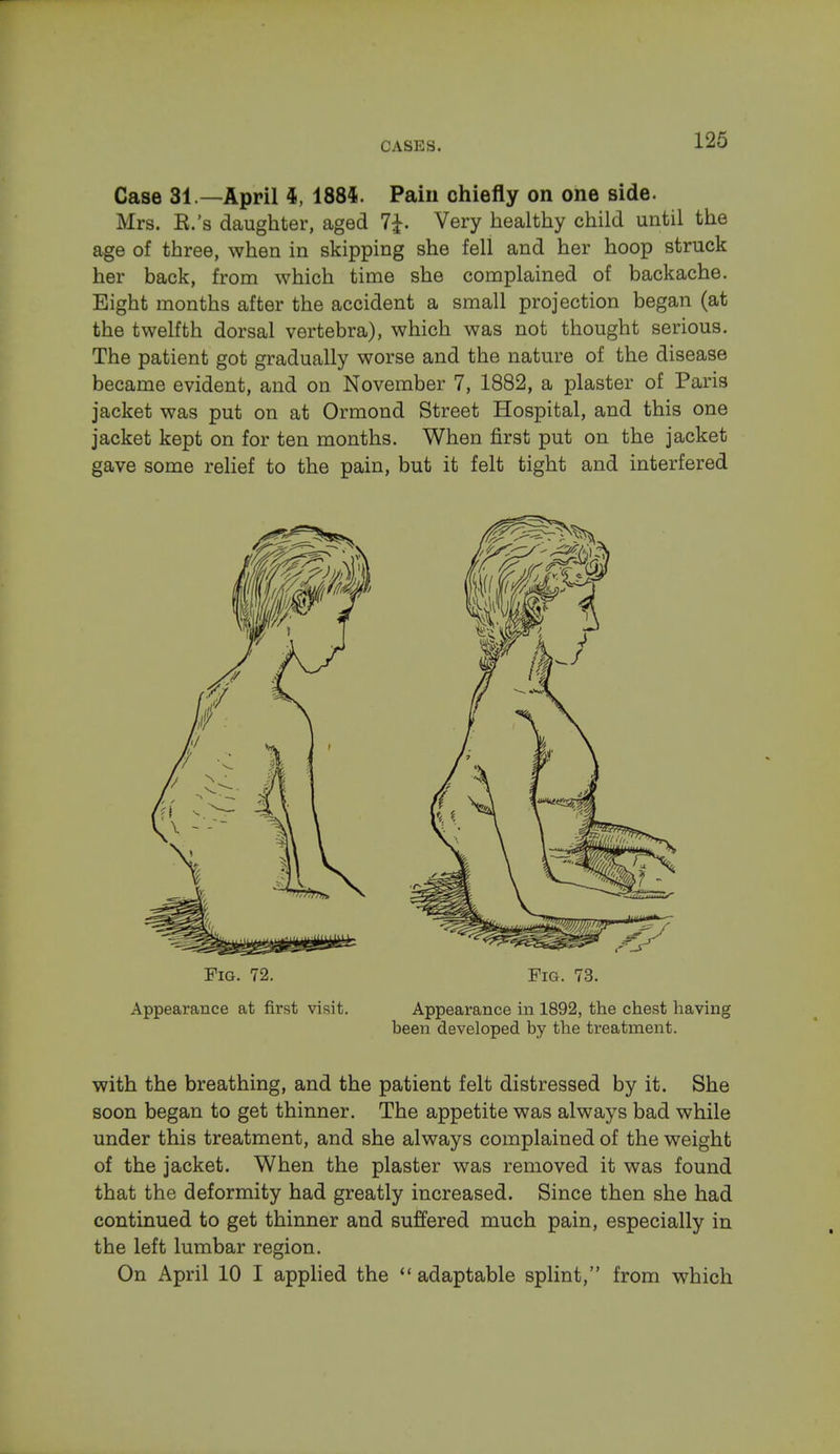 Case 31— April I, 1884. Pain chiefly on one side. Mrs. K.'s daughter, aged 7£. Very healthy child until the age of three, when in skipping she fell and her hoop struck her back, from which time she complained of backache. Eight months after the accident a small projection began (at the twelfth dorsal vertebra), which was not thought serious. The patient got gradually worse and the nature of the disease became evident, and on November 7, 1882, a plaster of Paris jacket was put on at Ormond Street Hospital, and this one jacket kept on for ten months. When first put on the jacket gave some relief to the pain, but it felt tight and interfered Fig. 72. Fig. 73. Appearance at first visit. Appearance in 1892, the chest having been developed by the treatment. with the breathing, and the patient felt distressed by it. She soon began to get thinner. The appetite was always bad while under this treatment, and she always complained of the weight of the jacket. When the plaster was removed it was found that the deformity had greatly increased. Since then she had continued to get thinner and suffered much pain, especially in the left lumbar region. On April 10 I applied the adaptable splint, from which