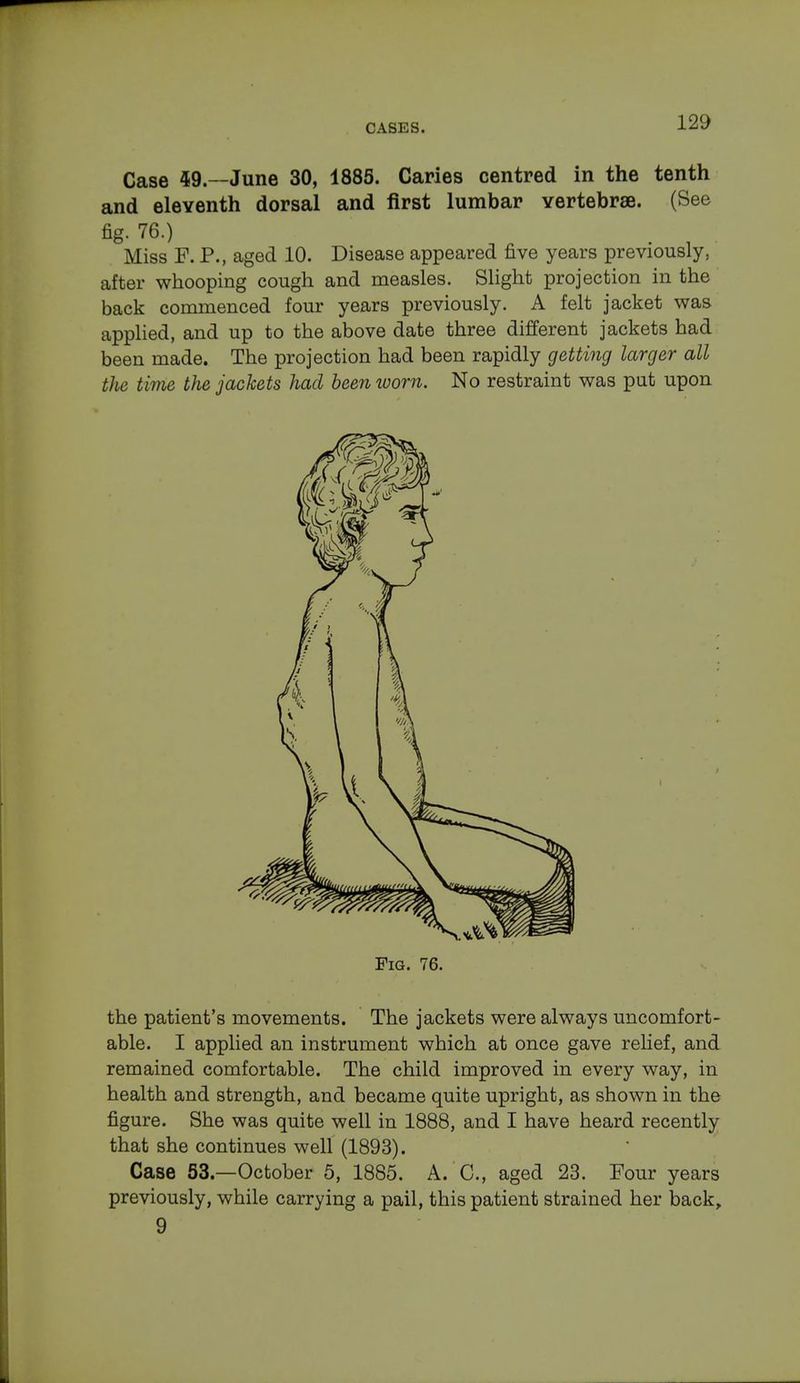 Case 49.—June 30, 1885. Caries centred in the tenth and eleventh dorsal and first lumbar vertebrae. (See fig. 76.) m Miss F. P., aged 10. Disease appeared five years previously, after whooping cough and measles. Slight projection in the back commenced four years previously. A felt jacket was capplied, and up to the above date three different jackets had been made. The projection had been rapidly getting larger all the time the jackets had been worn. No restraint was put upon Fig. 76. the patient's movements. The jackets were always uncomfort- able. I applied an instrument which at once gave relief, and remained comfortable. The child improved in every way, in health and strength, and became quite upright, as shown in the figure. She was quite well in 1888, and I have heard recently that she continues well (1893). Case 53.—October 5, 1885. A. C, aged 23. Four years previously, while carrying a pail, this patient strained her back, 9