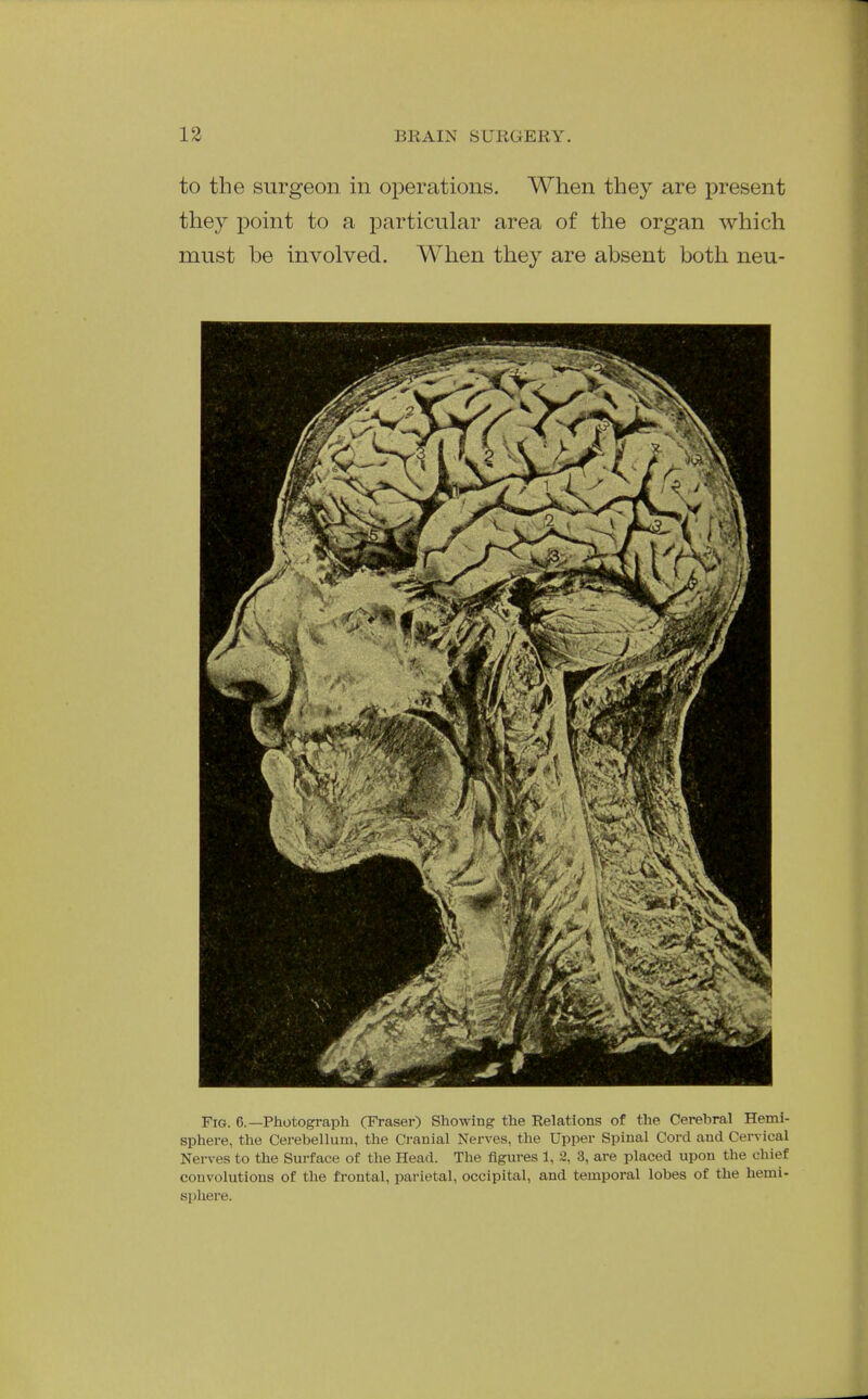 to the surgeon in operations. When they are present they point to a particular area of the organ which must be involved. When they are absent both neu- FiG. 6.—Photograph (Traser) Showing the Relations of the Cerebral Hemi- sphere, the Cerebellum, the Cranial Nerves, the Upper Spinal Cord and Cervical Nerves to the Surface of the Head. The figures 1, 2, 3, are placed upon the chief convolutions of the frontal, parietal, occipital, and temporal lobes of the hemi- sphere.