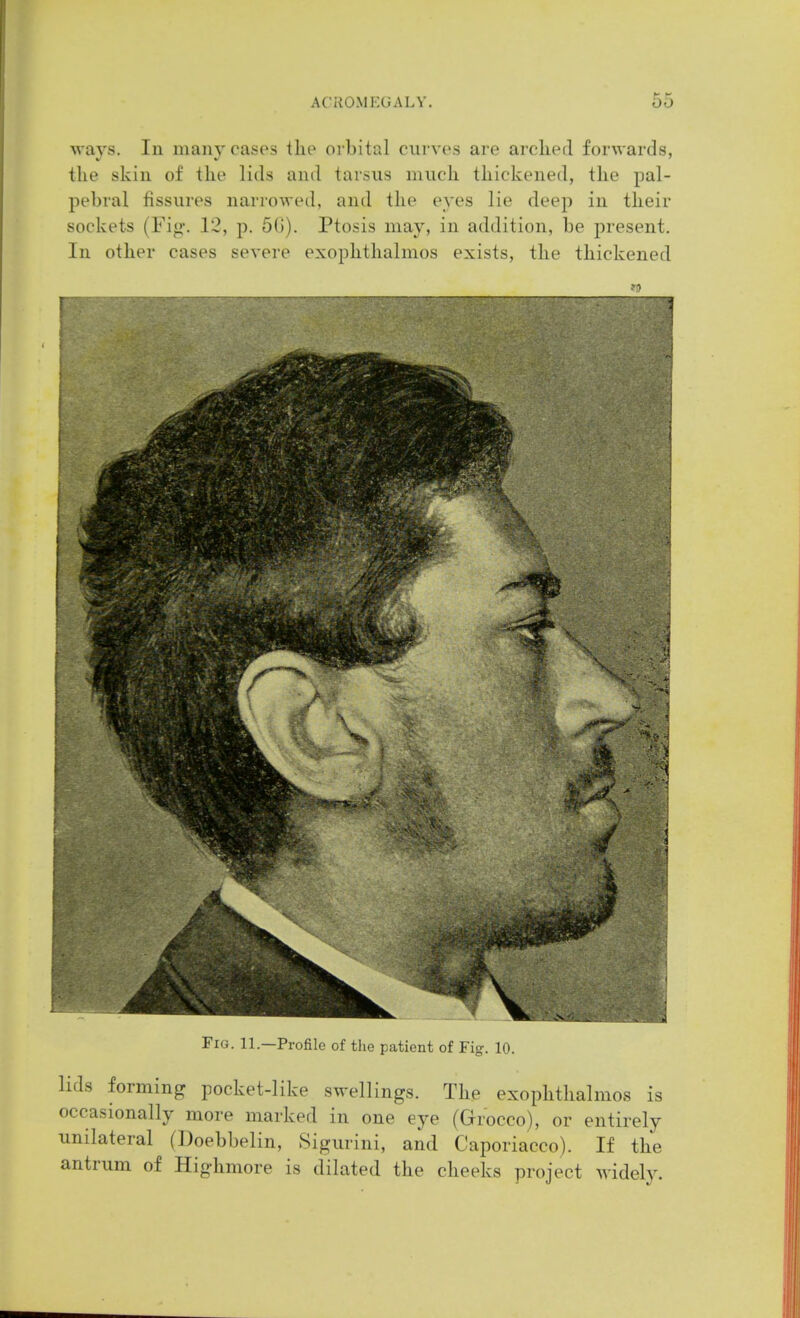 ways. In many cases the orbital curves are arched forwards, the skin of the lids and tarsus much thickened, the pal- pebral fissures narrowed, and the eyes lie deep in their sockets (Fig. 12, p. 66). Ptosis may, in addition, be present. In other cases severe exophthalmos exists, the thickened Fig. 11.—Profile of the patient of Fig. 10. lids forming pocket-like swellings. The exophthalmos is occasionally more marked in one eye (Grocco), or entirely unilateral (Doebbelin, Sigurini, and Caporiacco). If the antrum of Highmore is dilated the cheeks project widely.